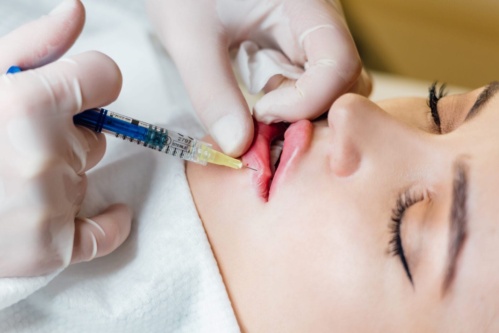 Lip Augmentation