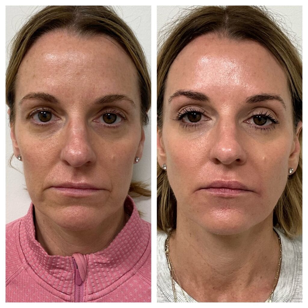 Filler Injections in Kansas City
