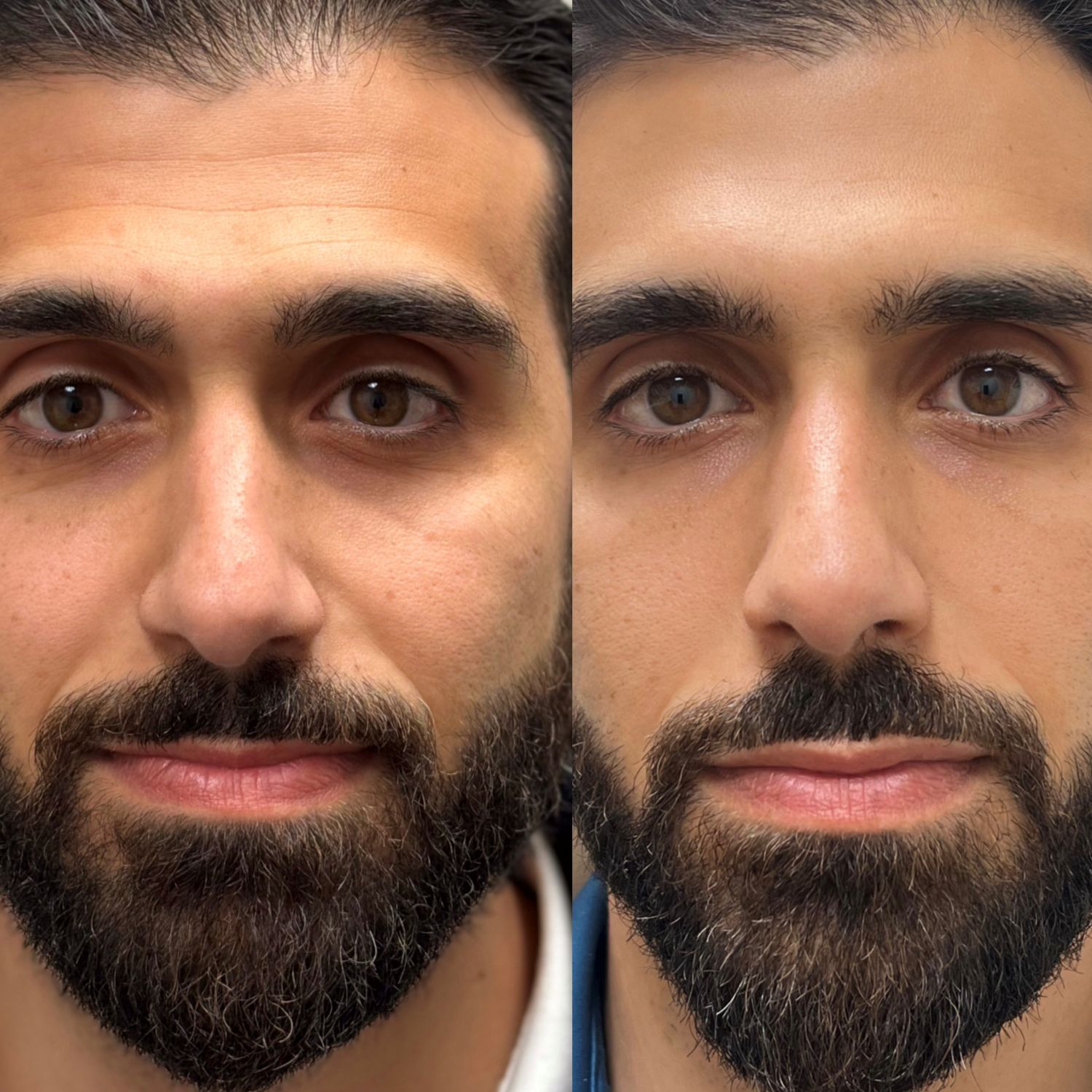 Regenerative Treatments Under Eye