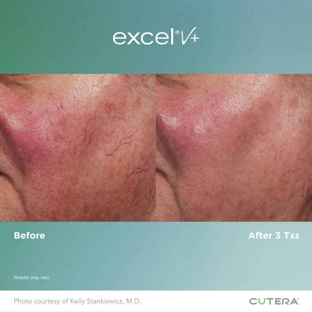 Pigmented Lesion Laser -Kansas City