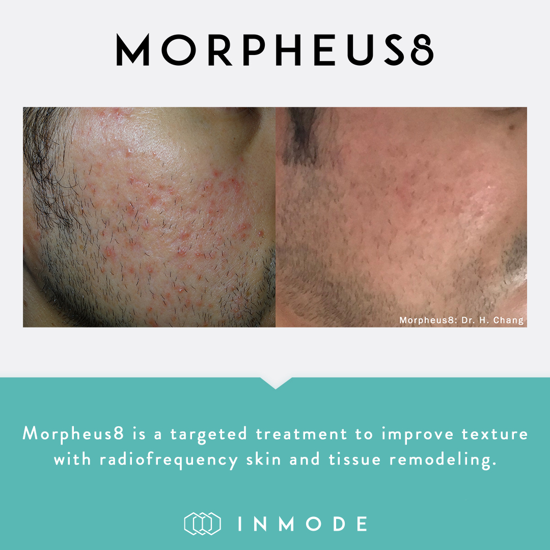 Radiofrequency Microneedling - Kansas City