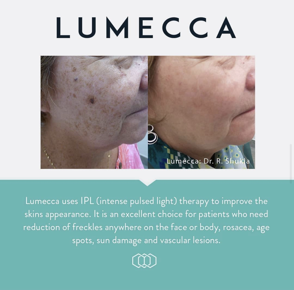 IPL Photofacial - Kansas City