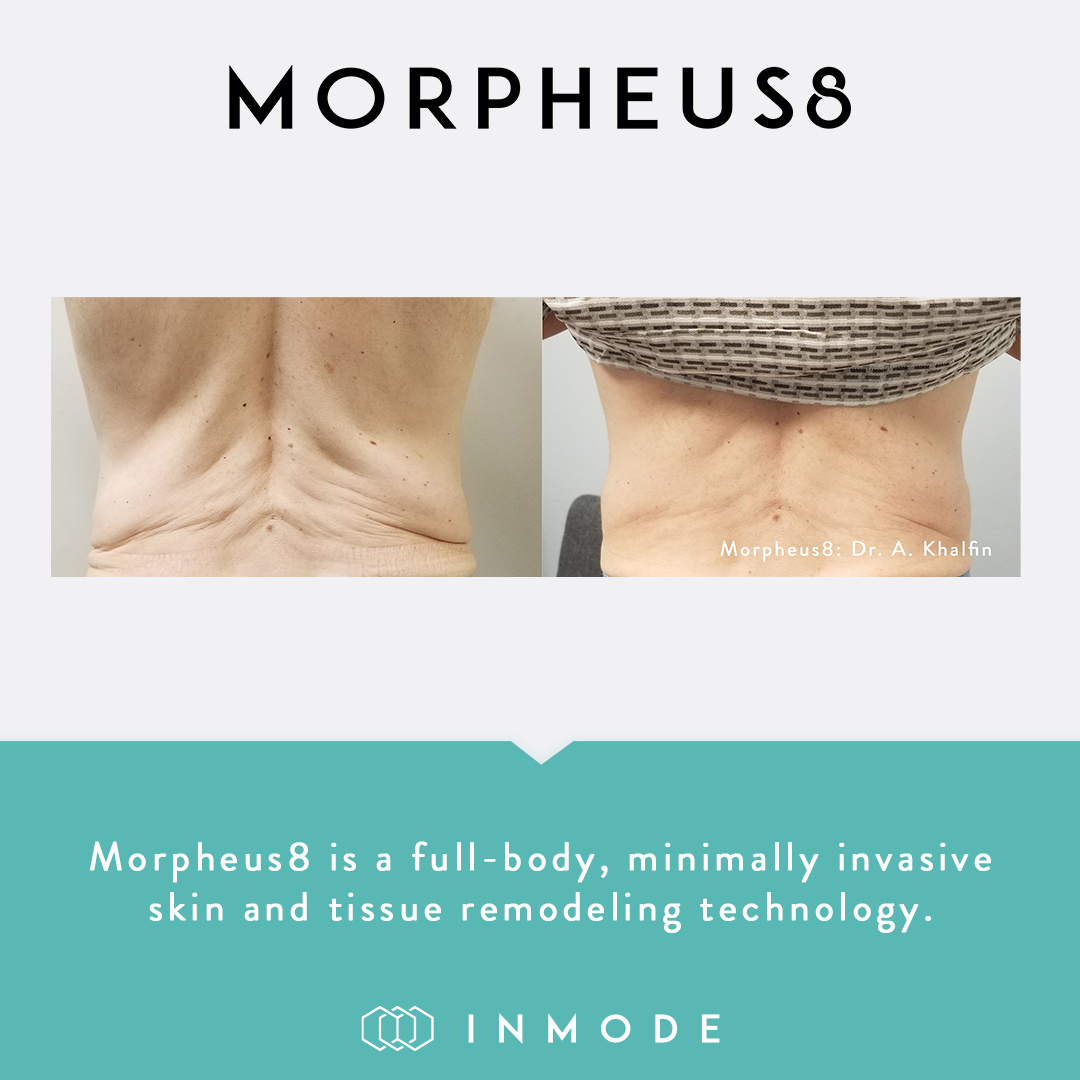 Radiofrequency Microneedling - Kansas City