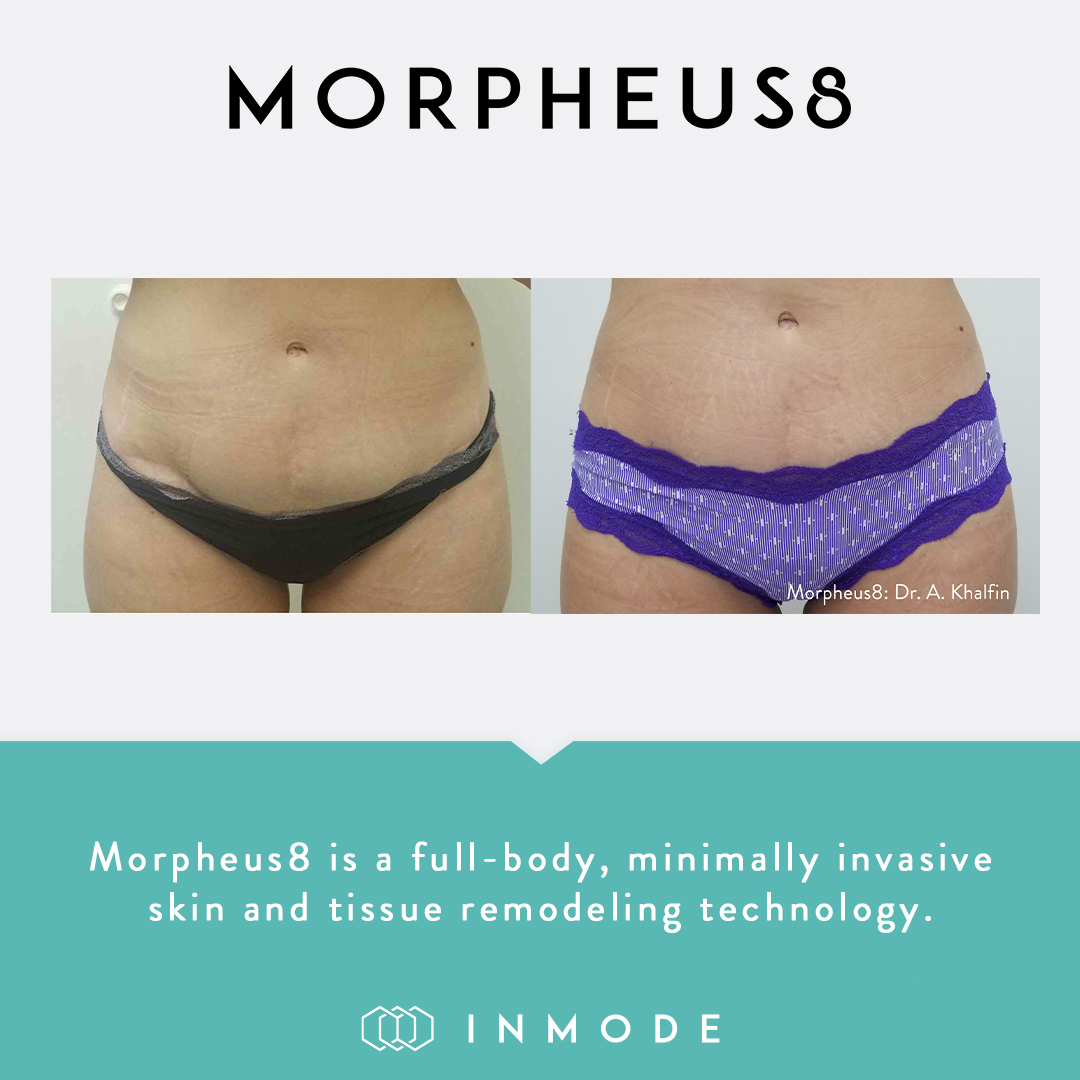Radiofrequency Microneedling - Kansas City