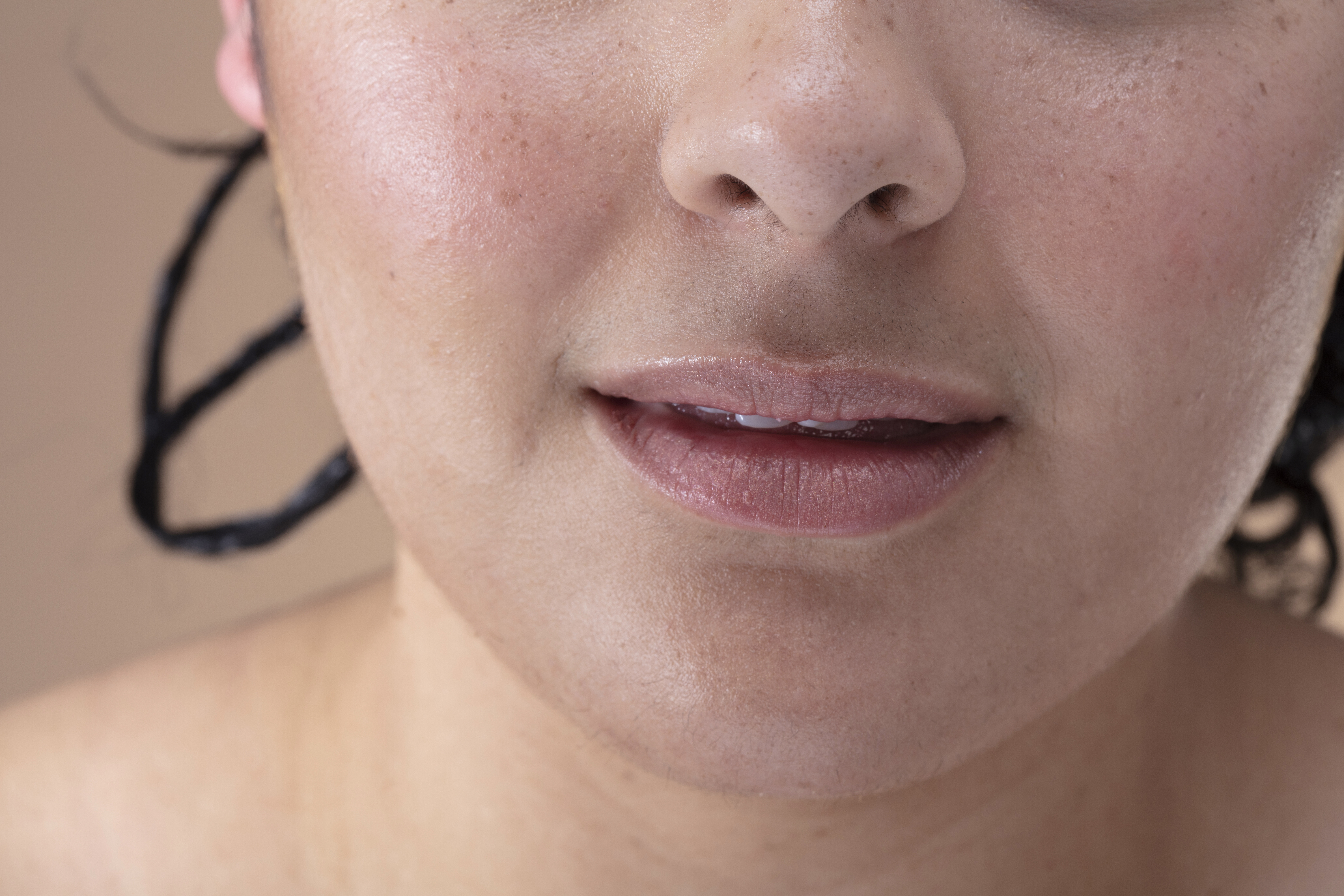 Cheeks -Laser Hair Removal - Kansas City
