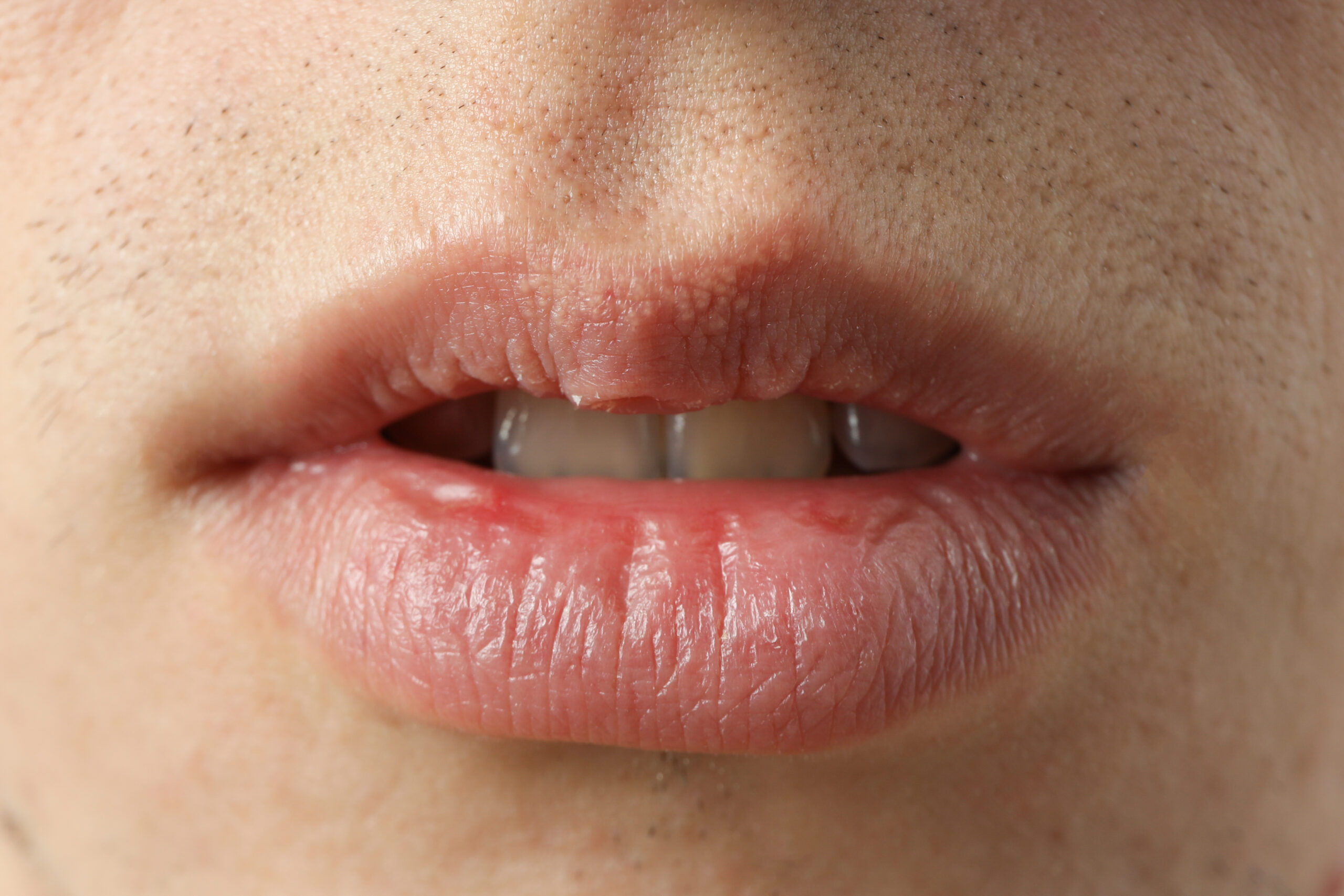 Upper Lip -Laser Hair Removal - Kansas City