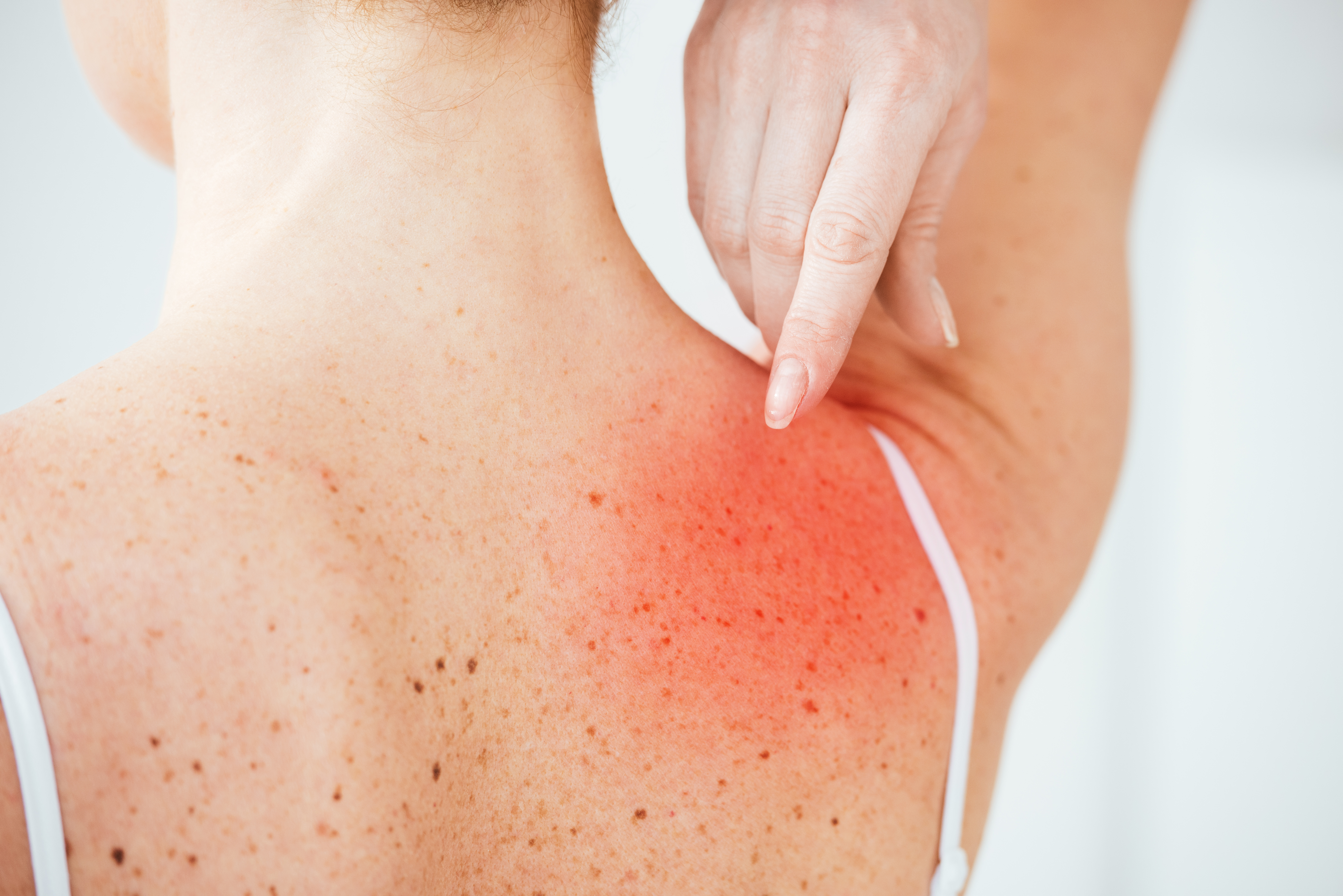 Shoulders - IPL Photofacial - Kansas City