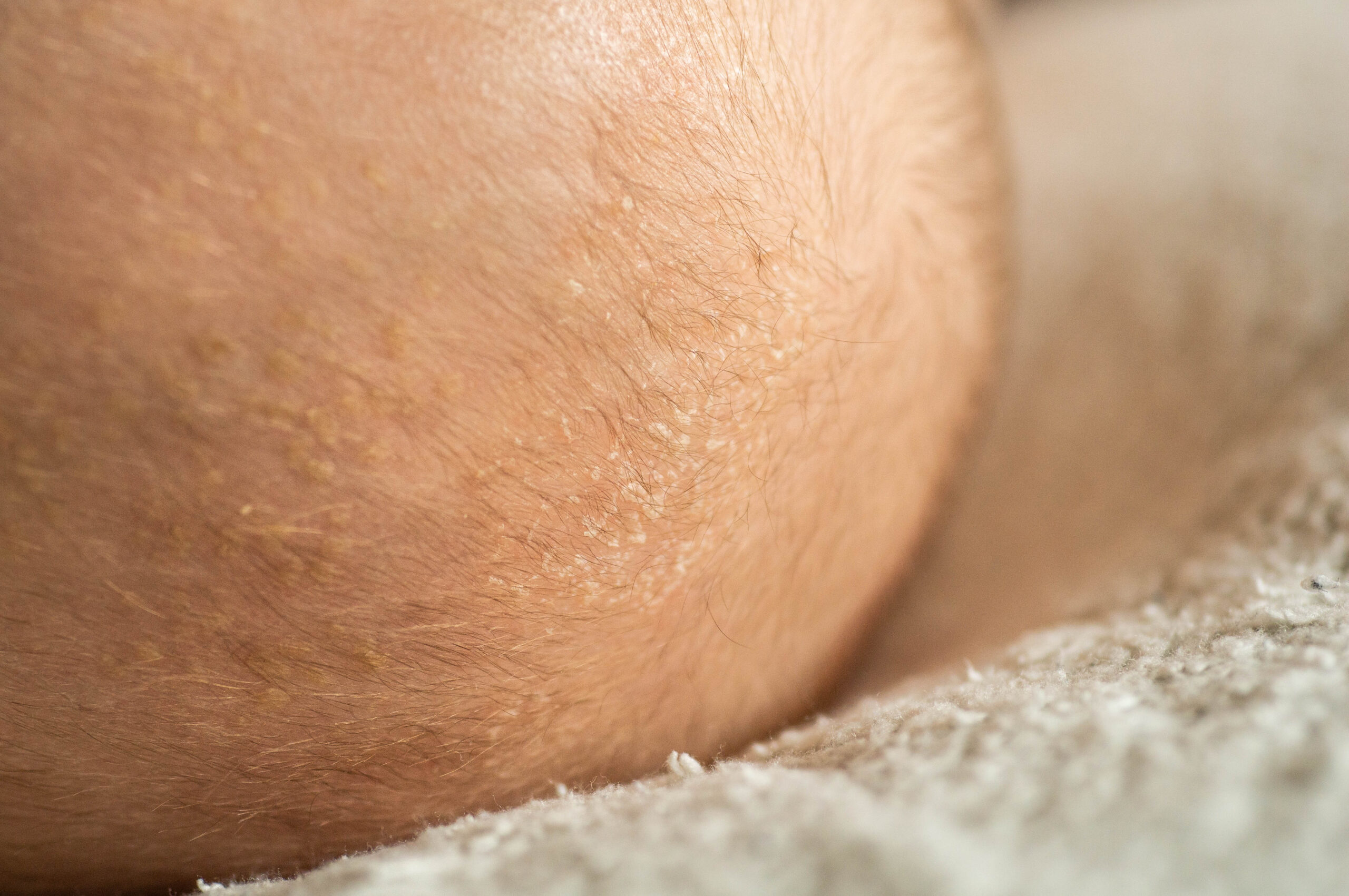Buttocks -Laser Hair Removal - Kansas City