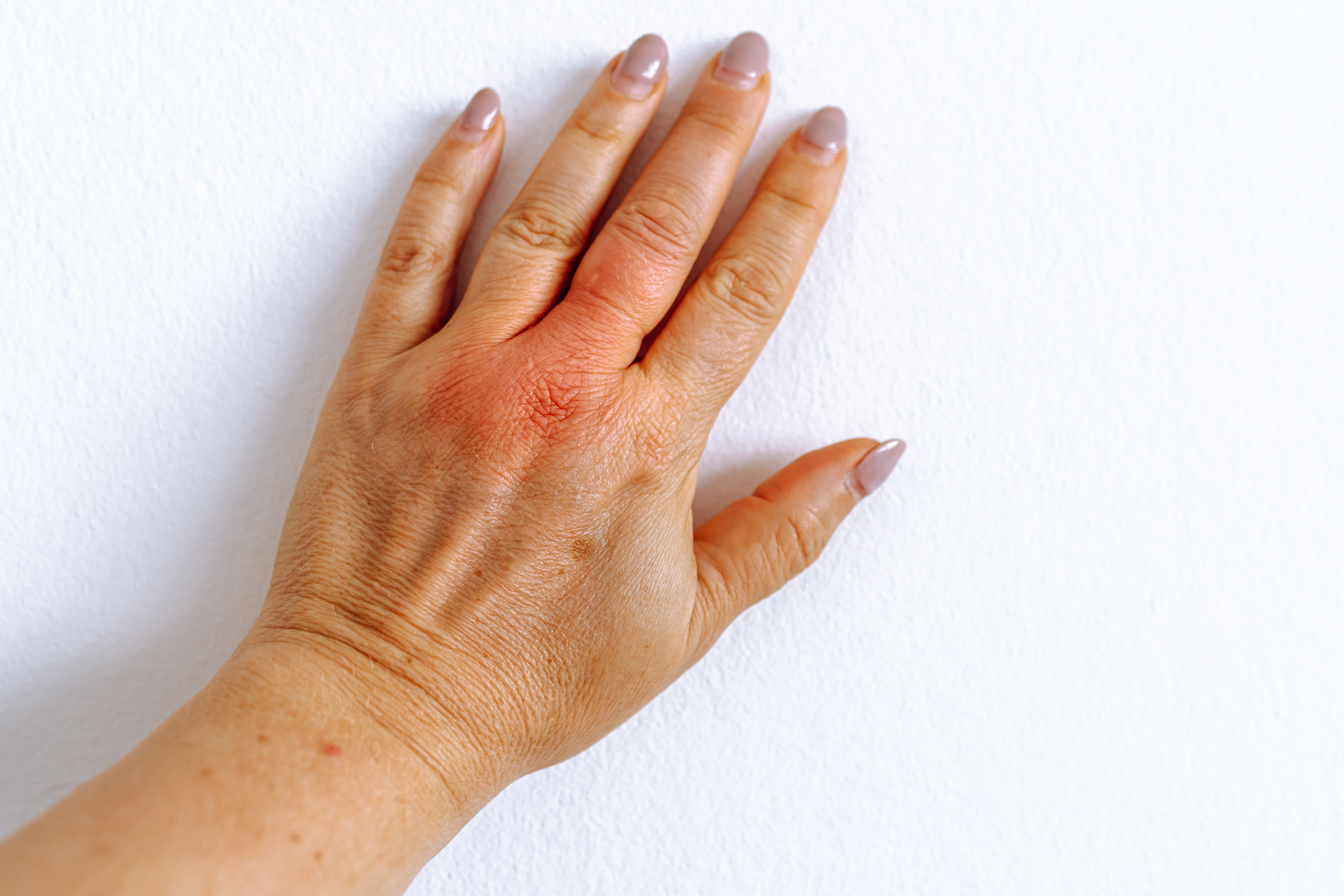 Hands - IPL Photofacial - Kansas City