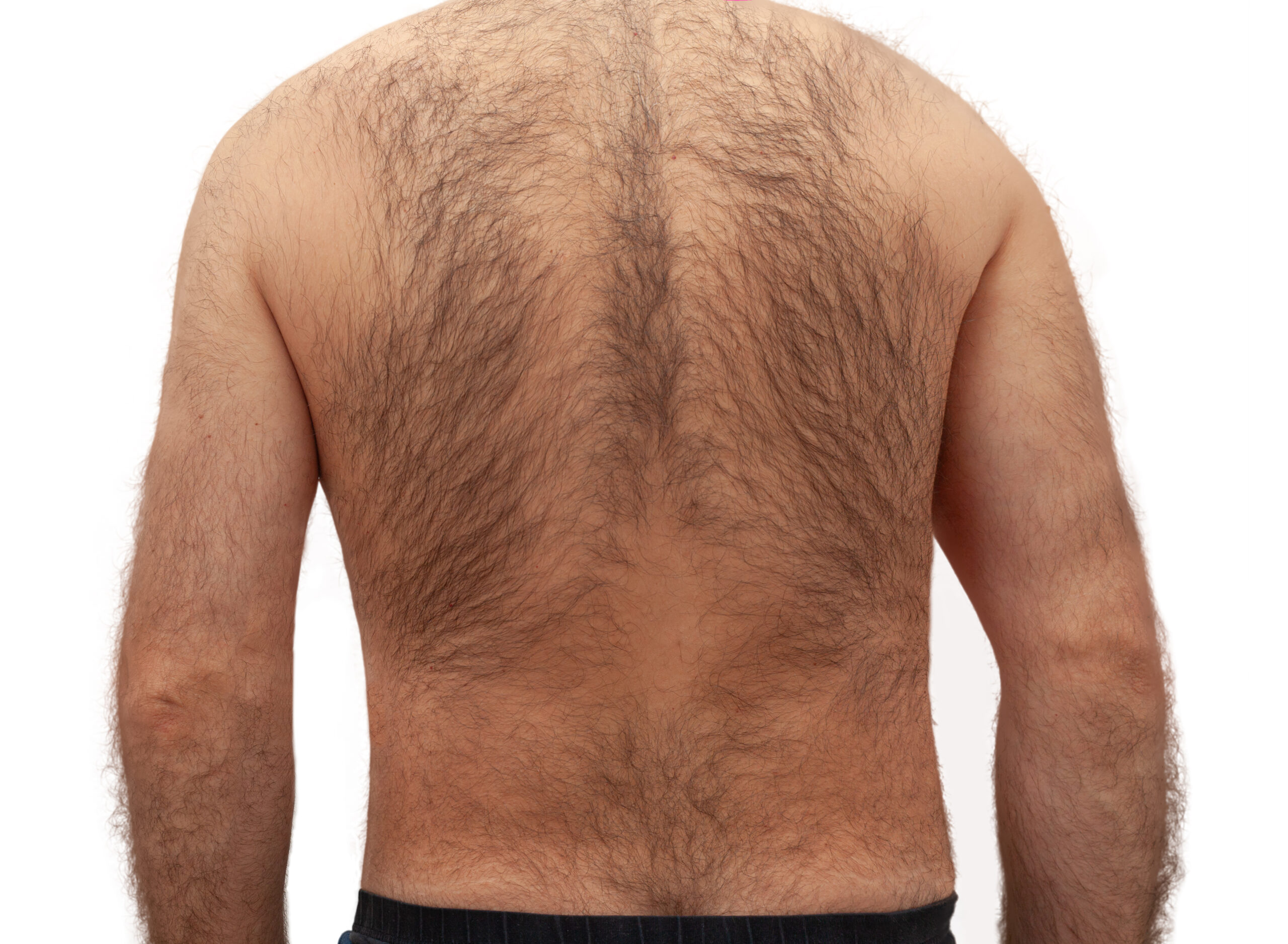 Back -Laser Hair Removal - Kansas City