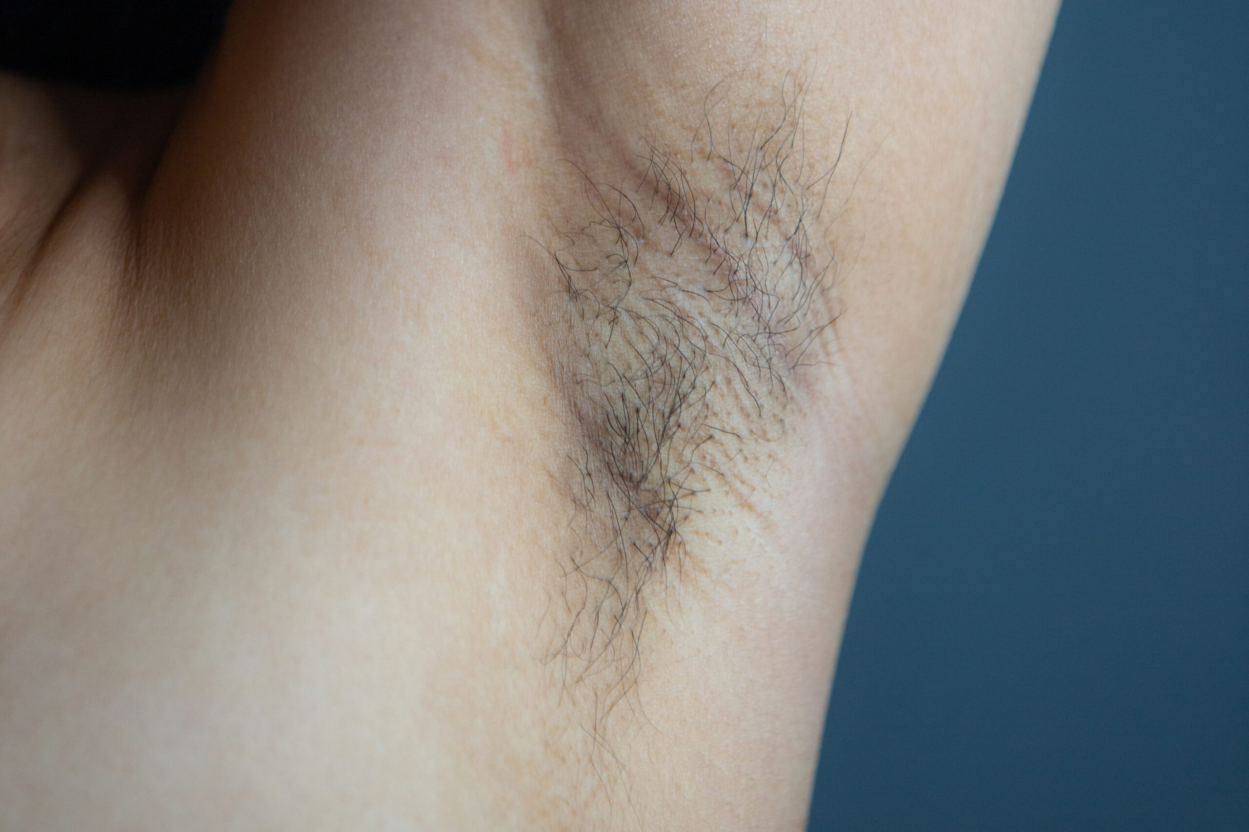 Underarms -Laser Hair Removal - Kansas City