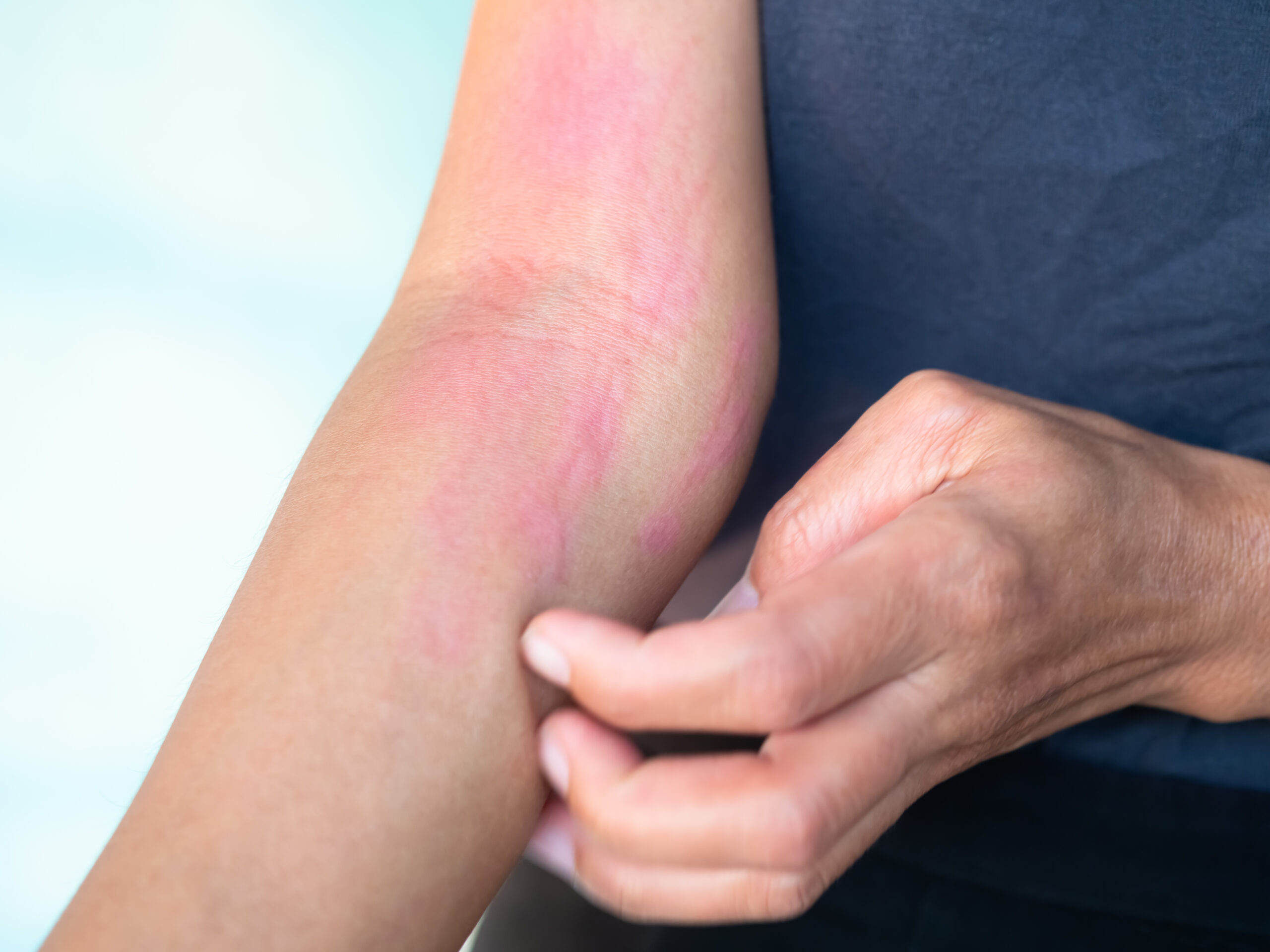Arms - IPL Photofacial - Kansas City