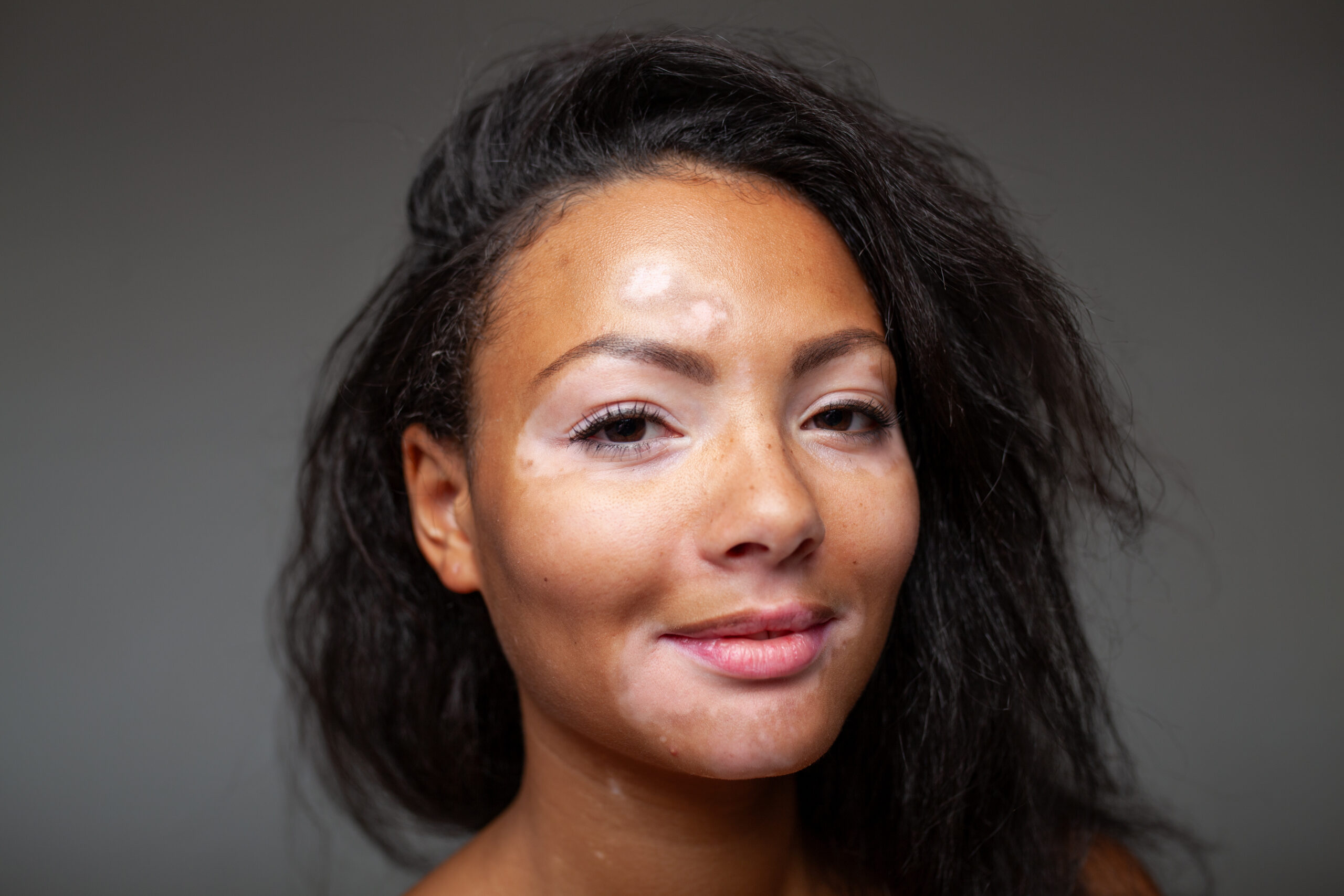 Uneven Skin Tone & Hyperpigmentation Treatment - Kansas City