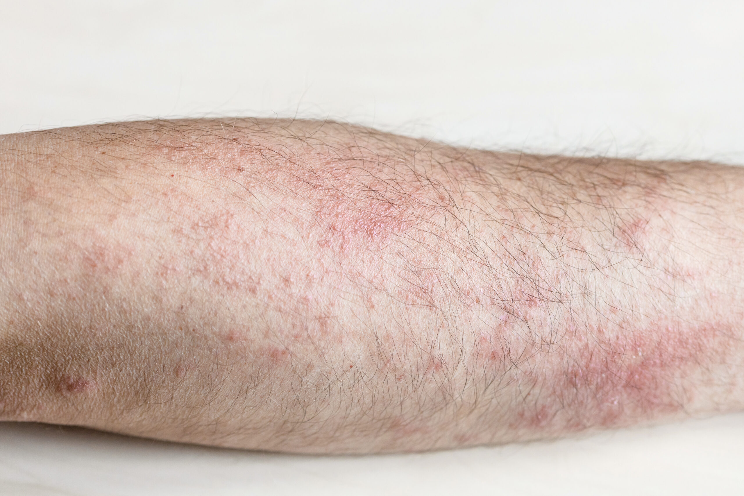 Forearms -Laser Hair Removal - Kansas City