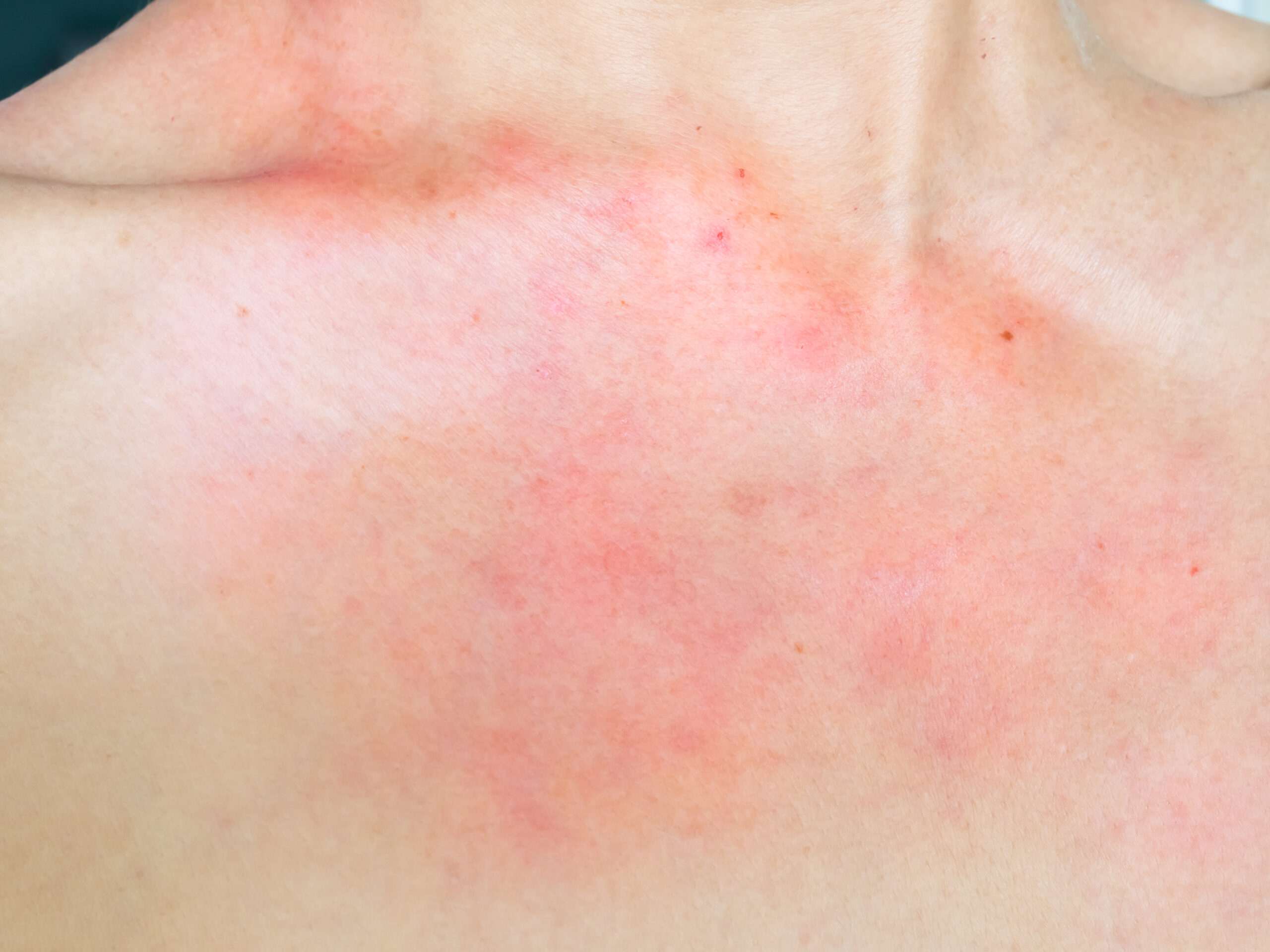 Neck - IPL Photofacial - Kansas City