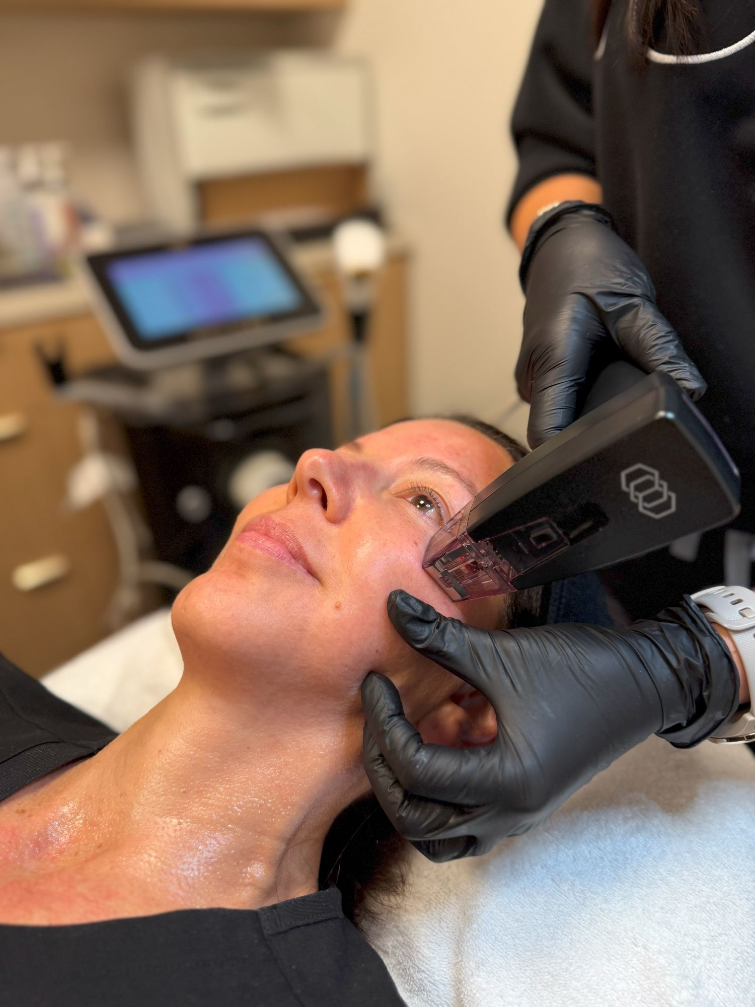 Morpheus 8 Radio Frequency Microneedling at SOKO Aesthetics