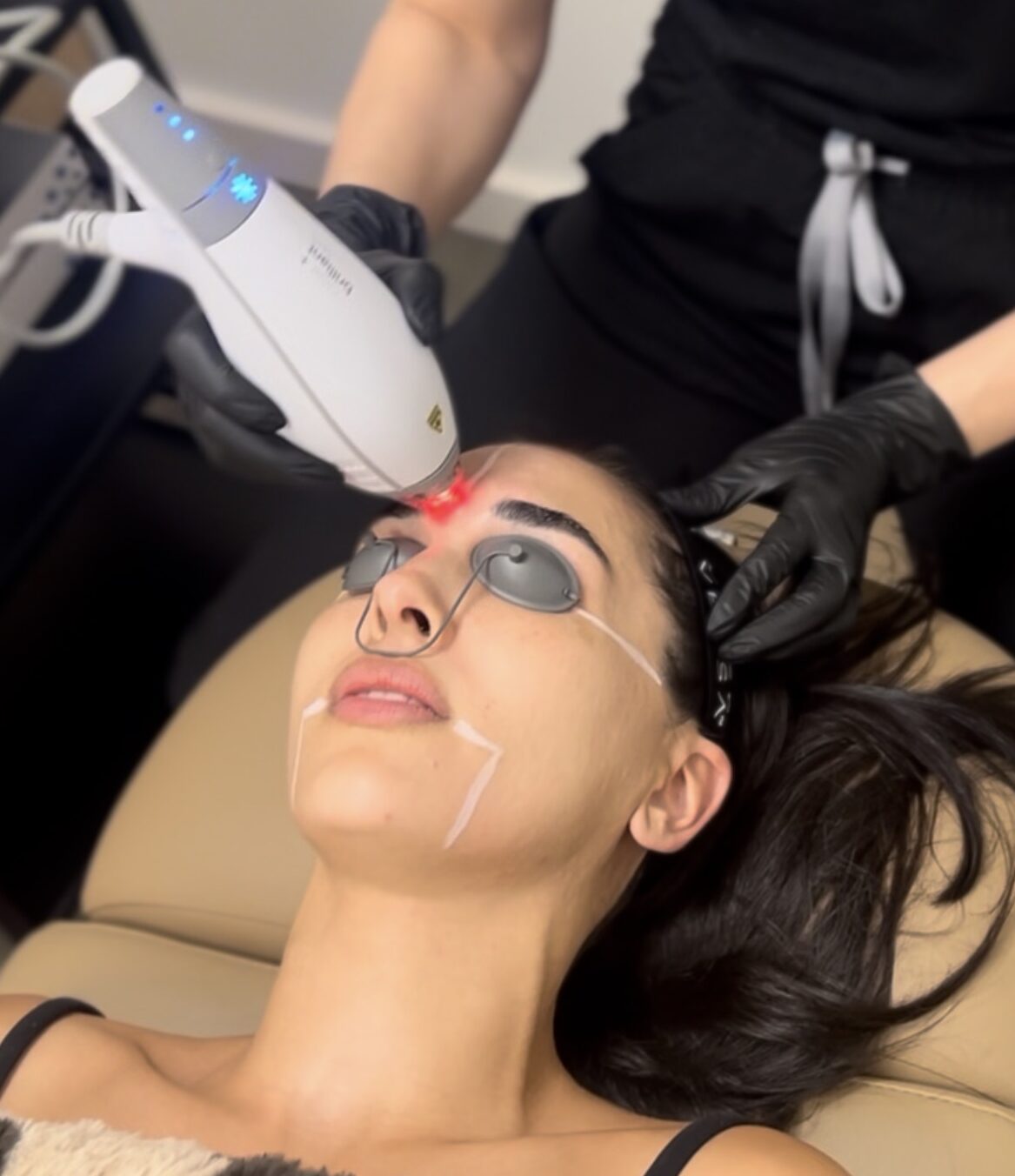 Clear & Brilliant Baby Fractional Laser