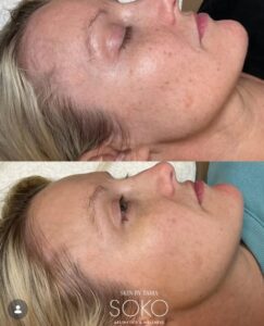 IPL Brown Spot Removal Kansas City