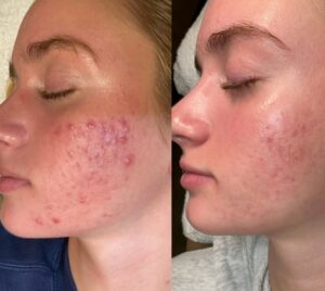 Acne Treatment Kansas City