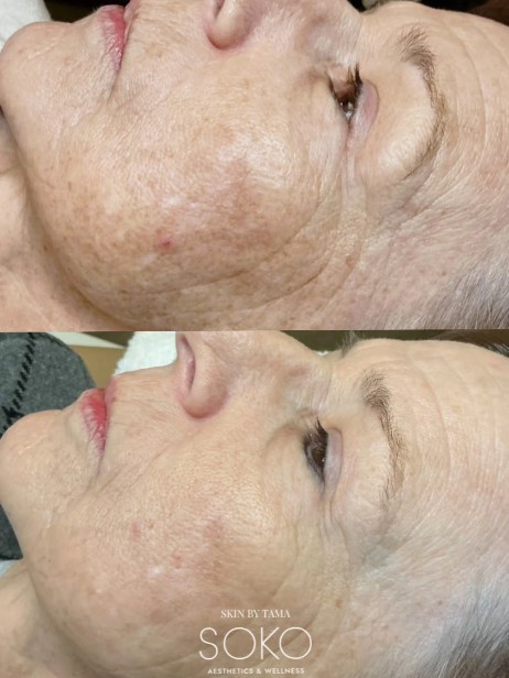 IPL Brownspot Removal Kansas City