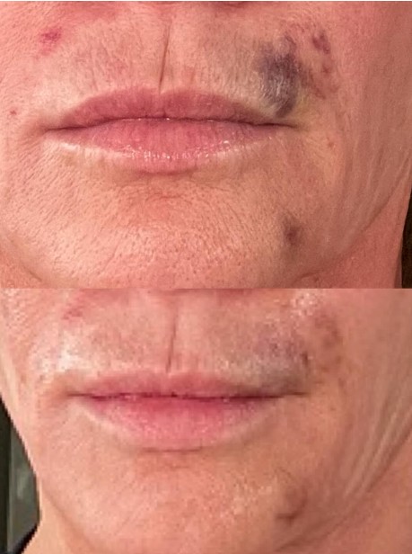 Bruise Removal Kansas City