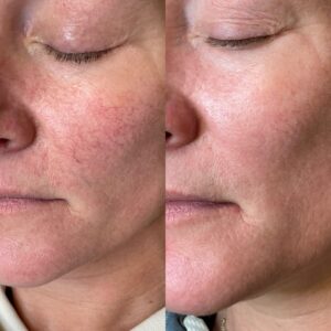 Rosacea Treatment Kansas City