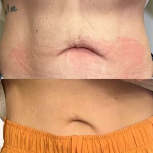 Body Tightening Kansas City