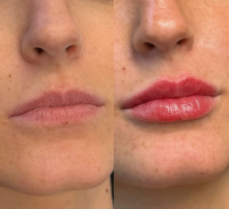 SOKO lip filler patient, before on the left and after on the right