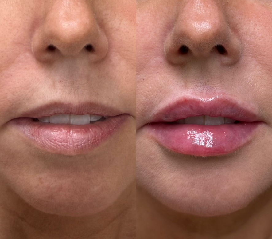 Lip filler before and after: before left, after right