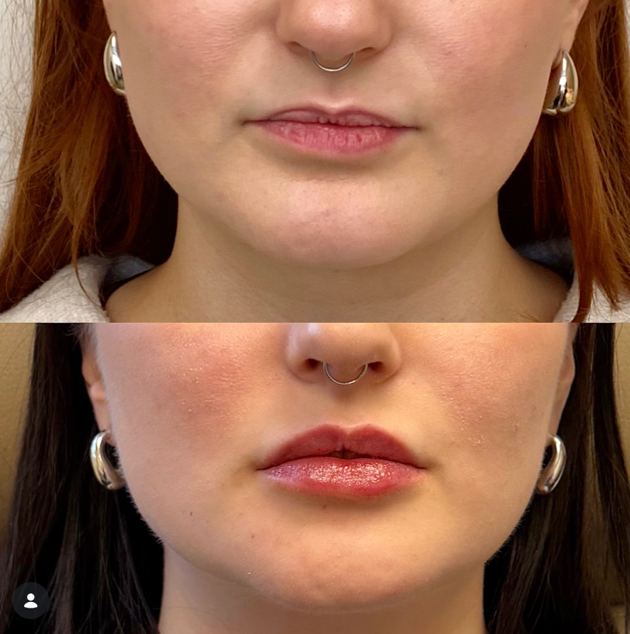 SOKO lip enhancement before on top and after below