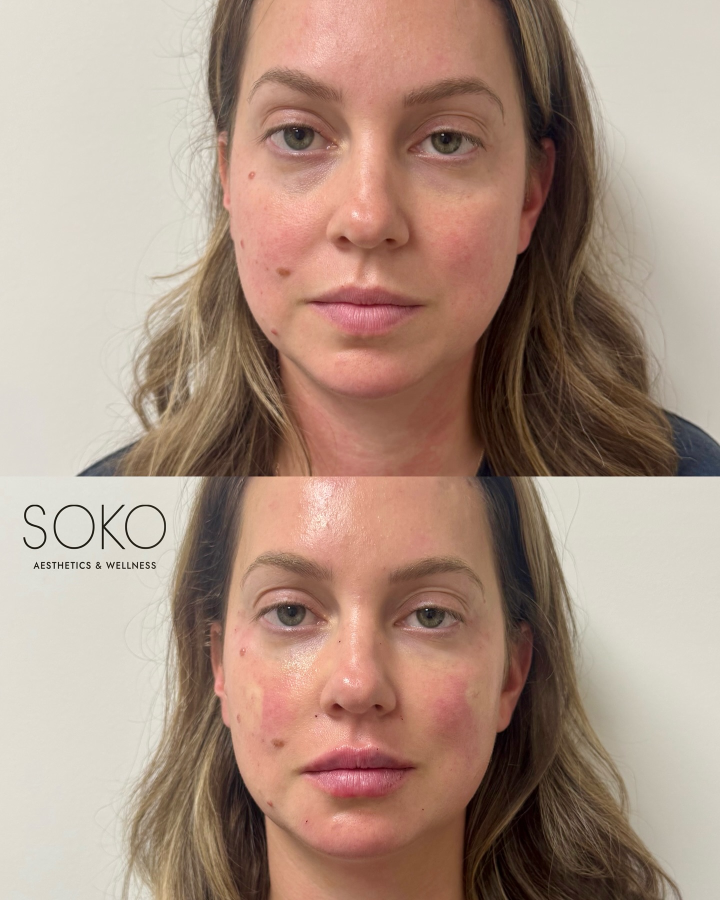 Before and immediately after lip filler, advanced biologics, and tox! Beautiful before and after