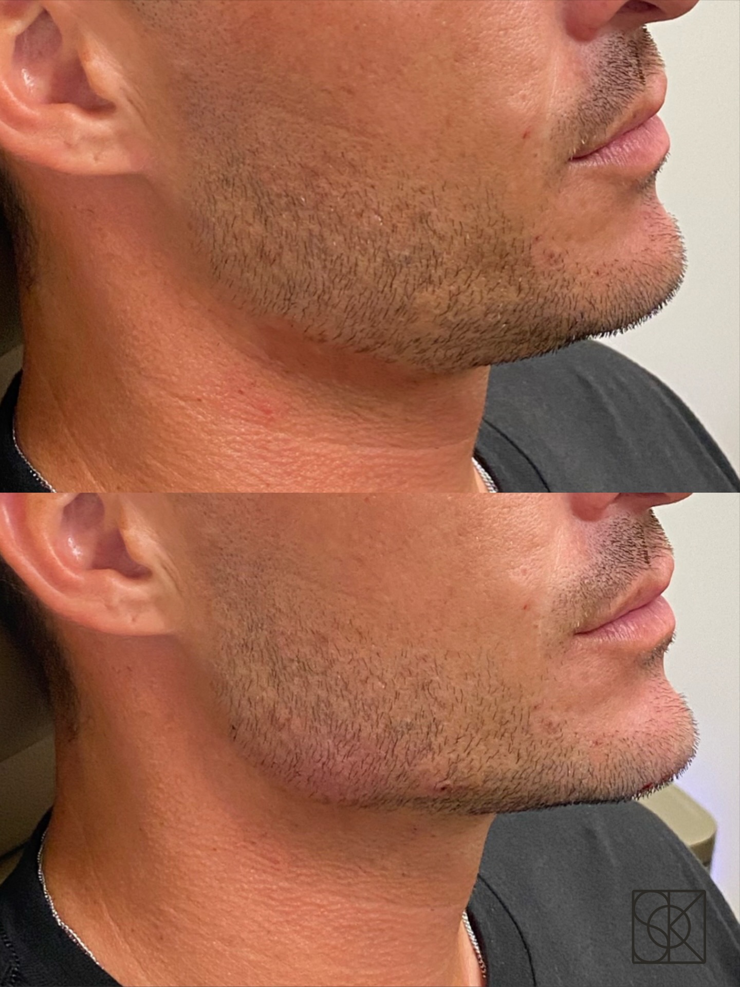 Poll 👇 So handsome before and after! Jawline + chin support for subtle strength