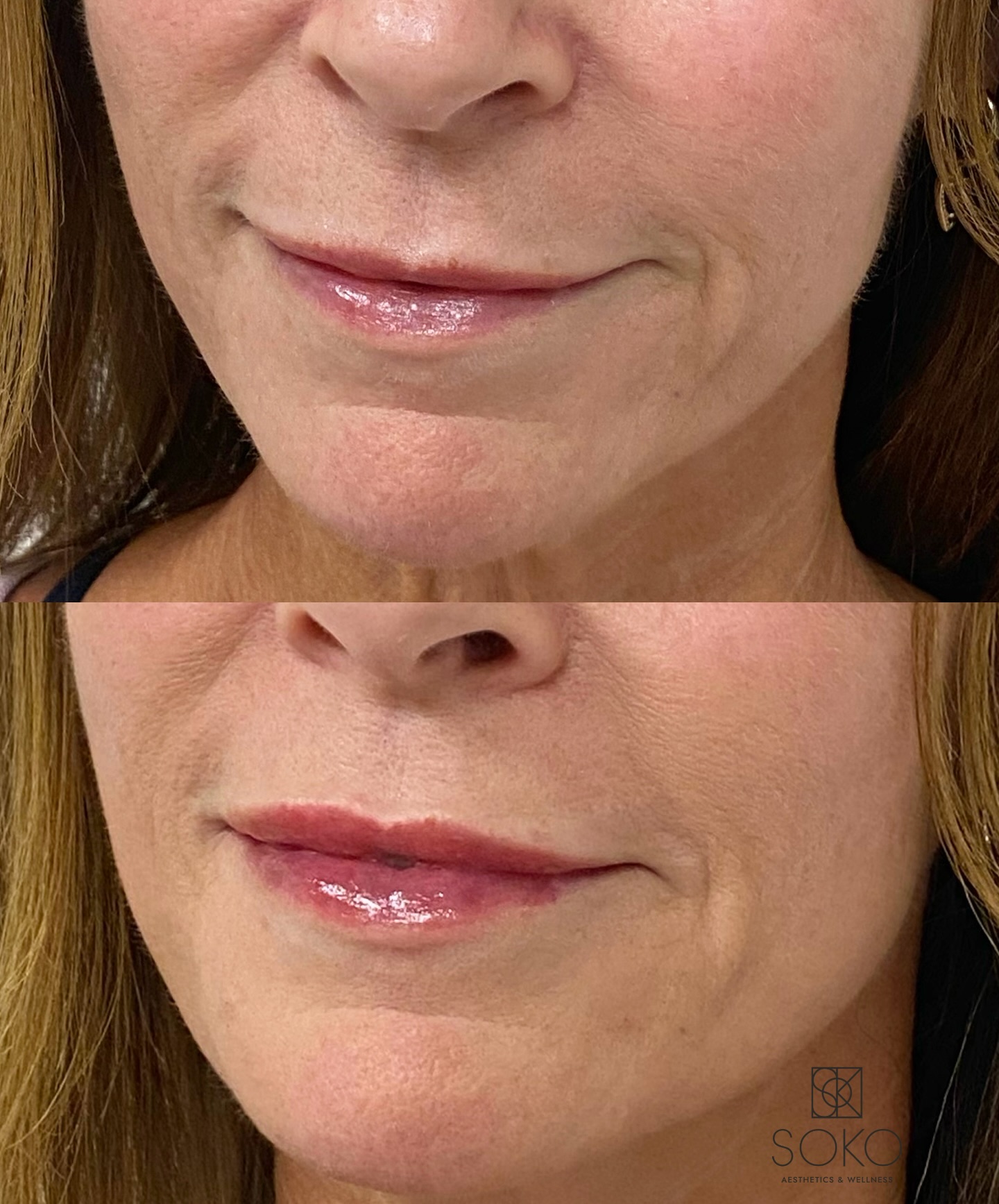 Top photo is round 2, bottom is round 3 of lip filler! I loved