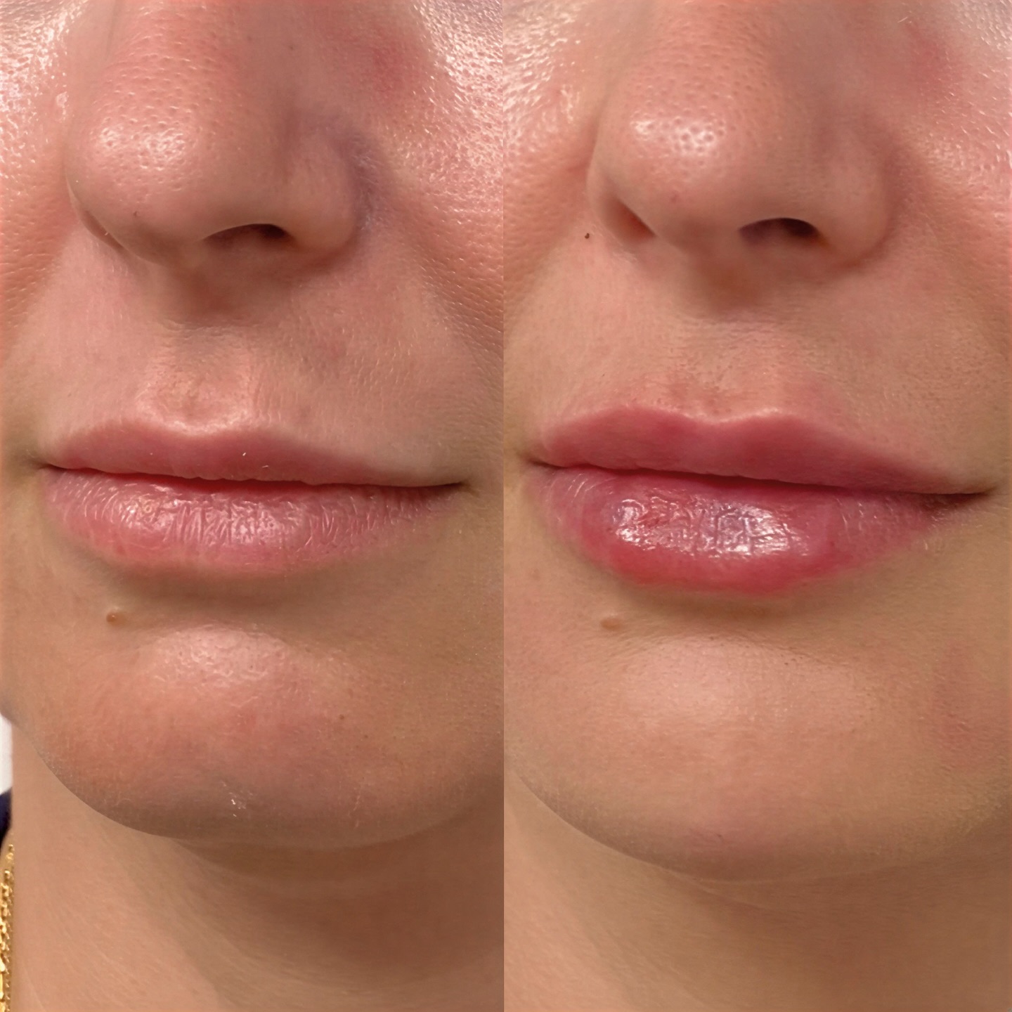 Let’s talk about how to keep your lip filler undetectable - products matter. If
