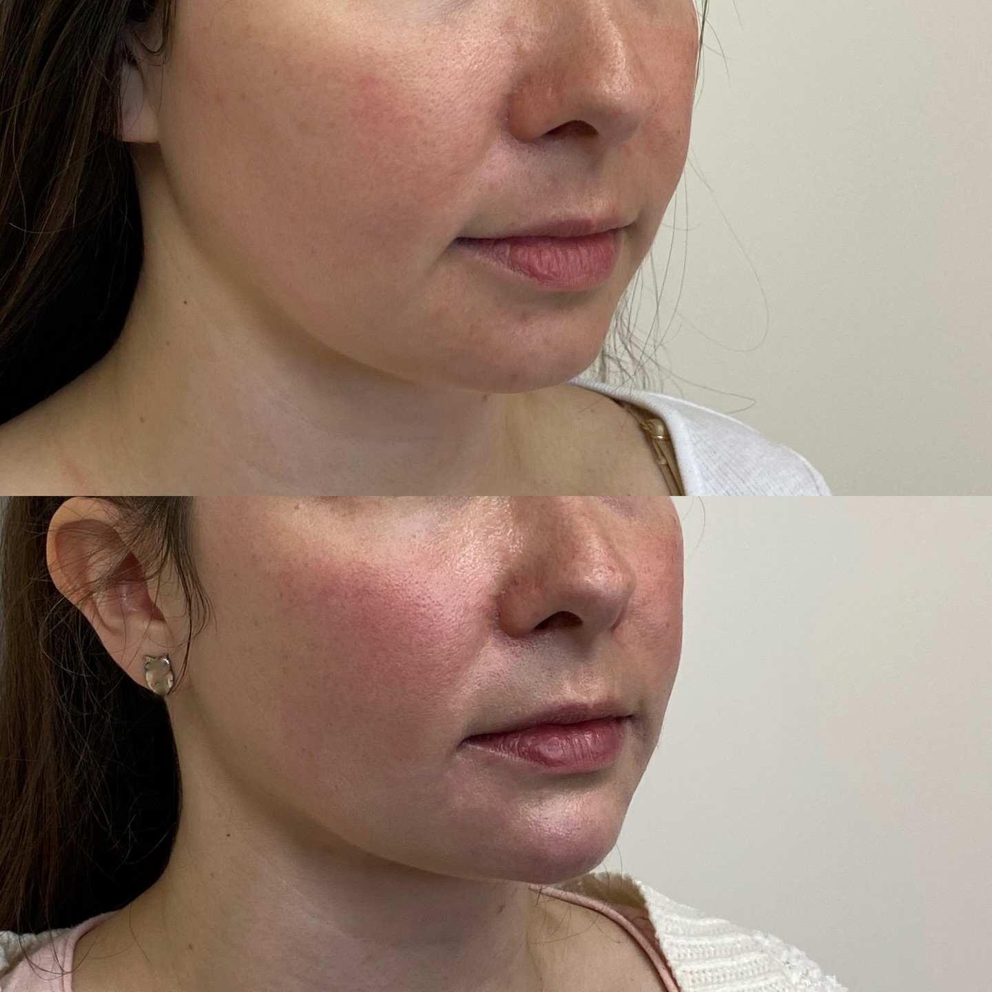 Two sessions lower face rejuvenation for this beauty! 😍Jawline elongation and chin shadow treatment