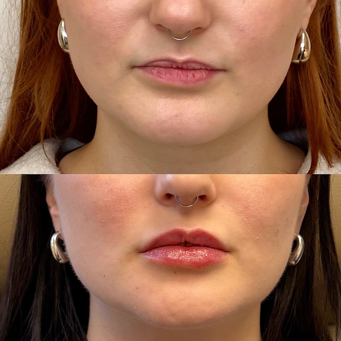 🫦……Not all treatments are one and done! I’m so grateful this beautiful patient put