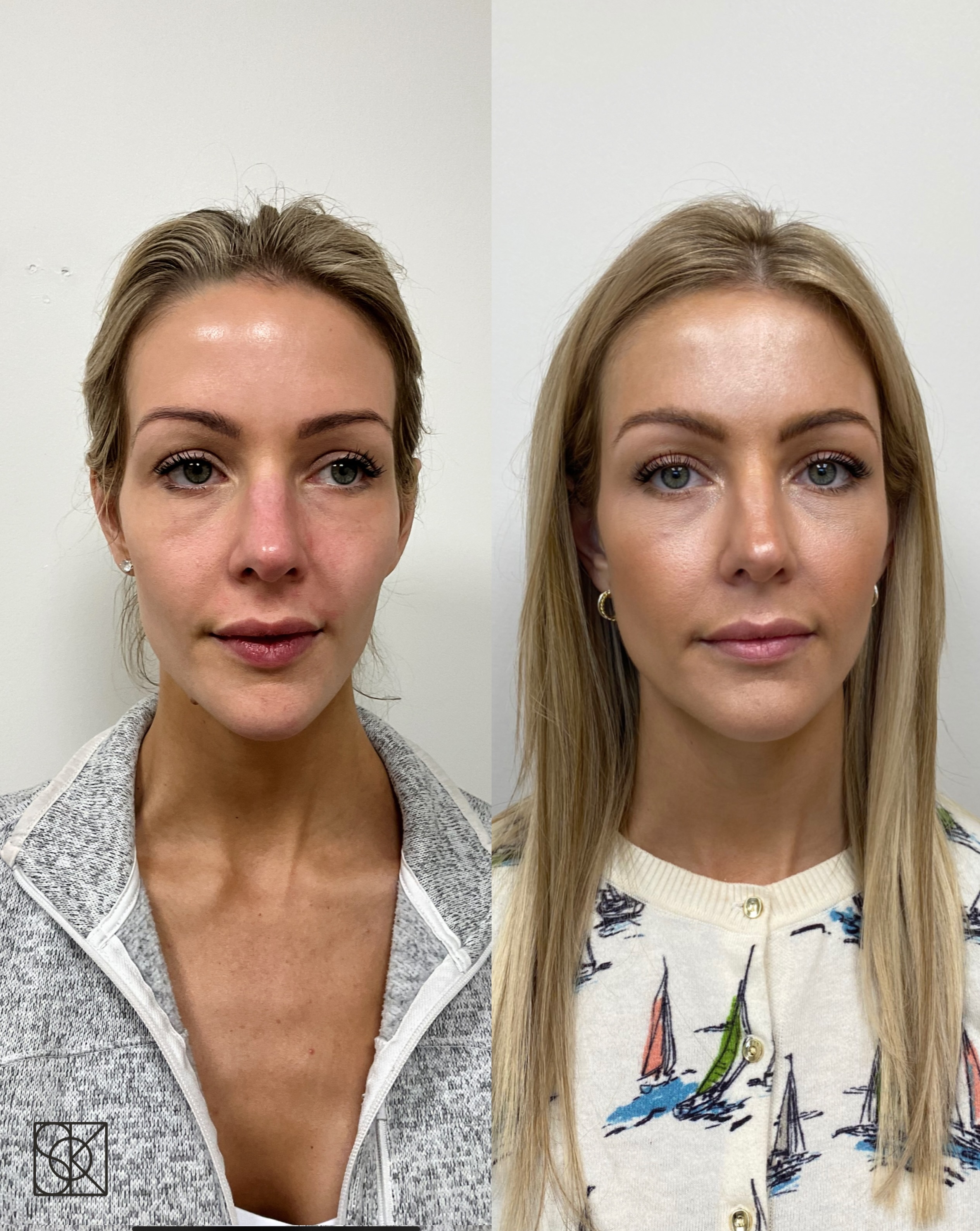 This patient’s first appointment with SOKO was one year ago! 🤍 Comment “PRIME” to