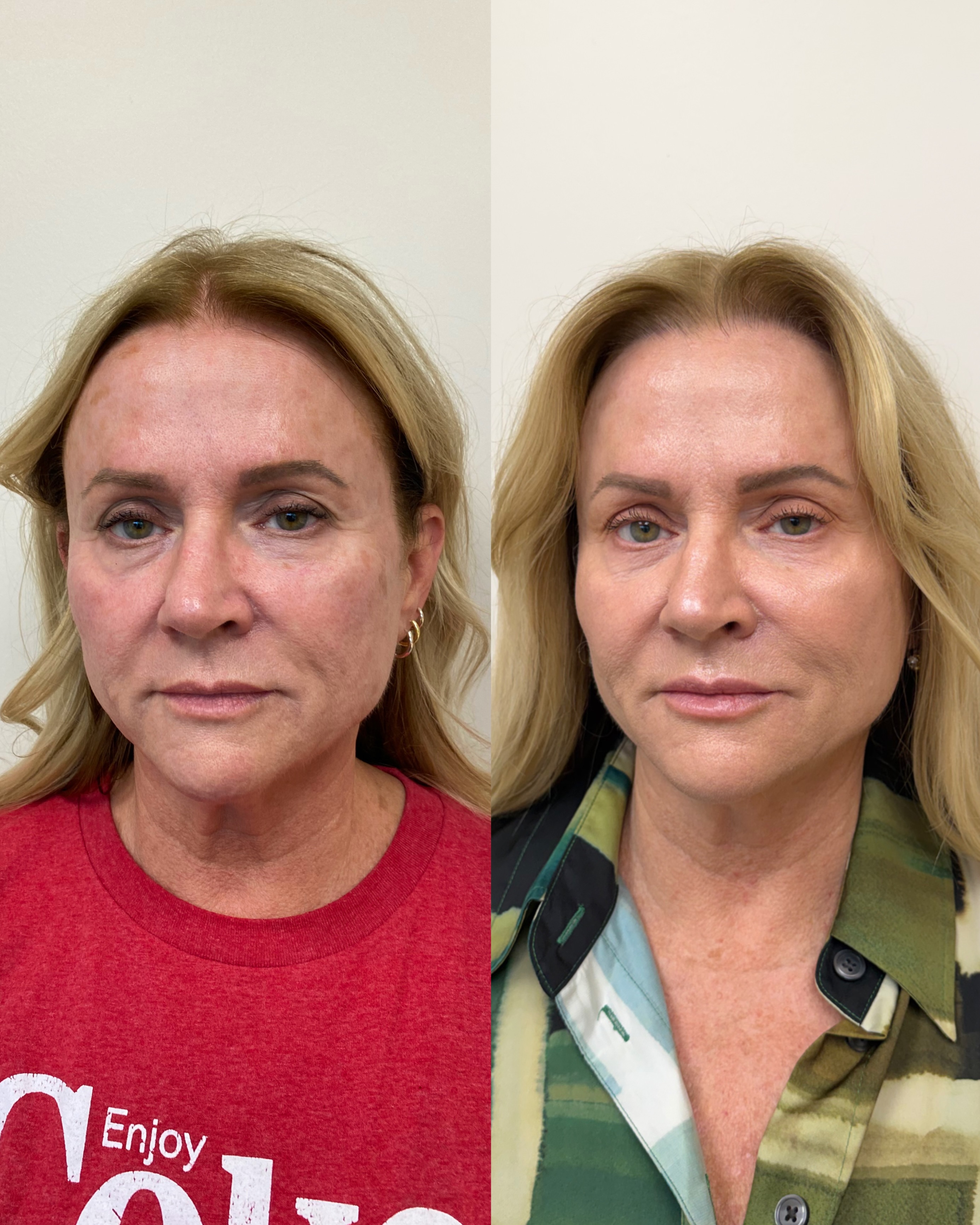 First photo taken two weeks post treatment. Swipe to see immediately post treatment! She
