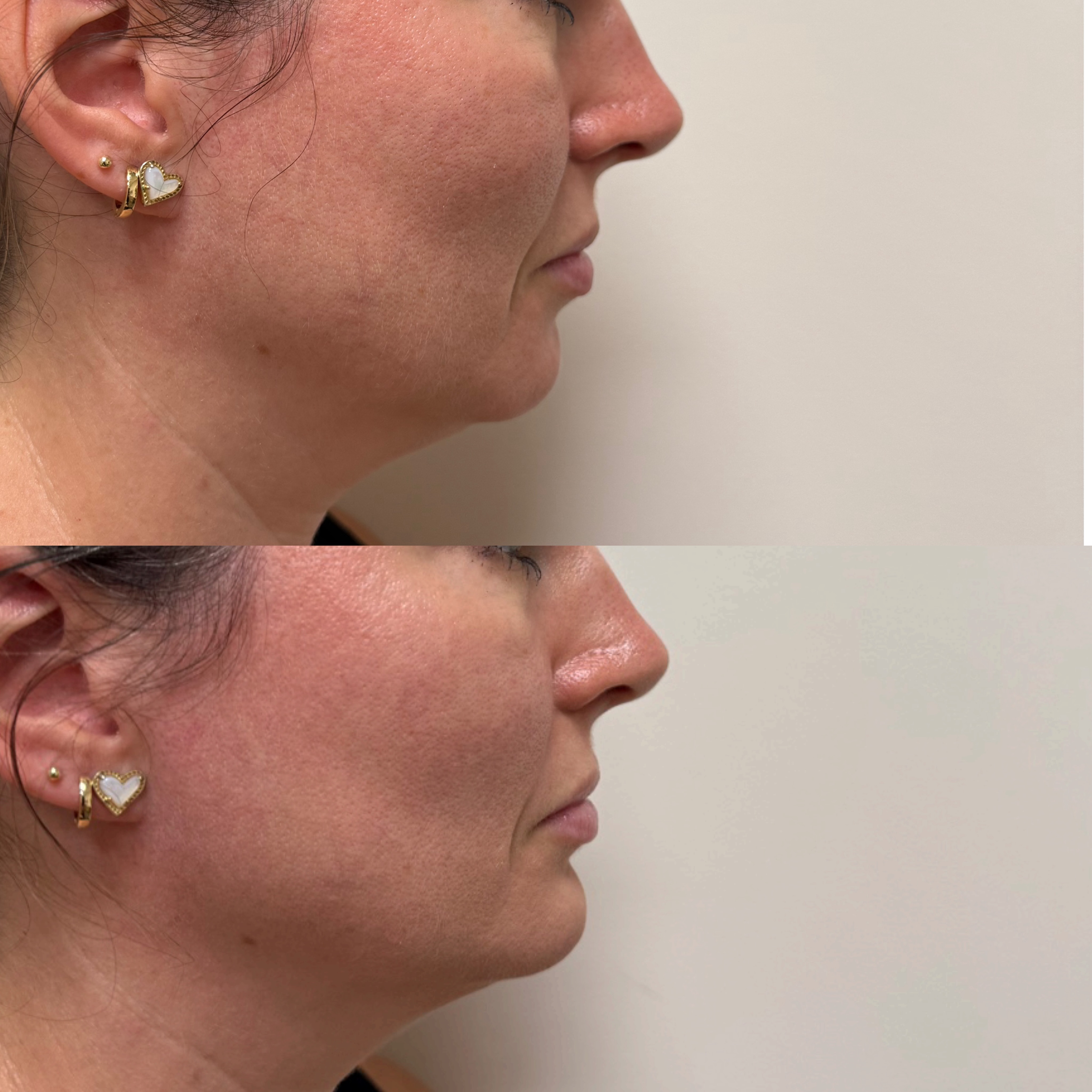 A subtle change can make a big difference. ✨ Chin filler is one of
