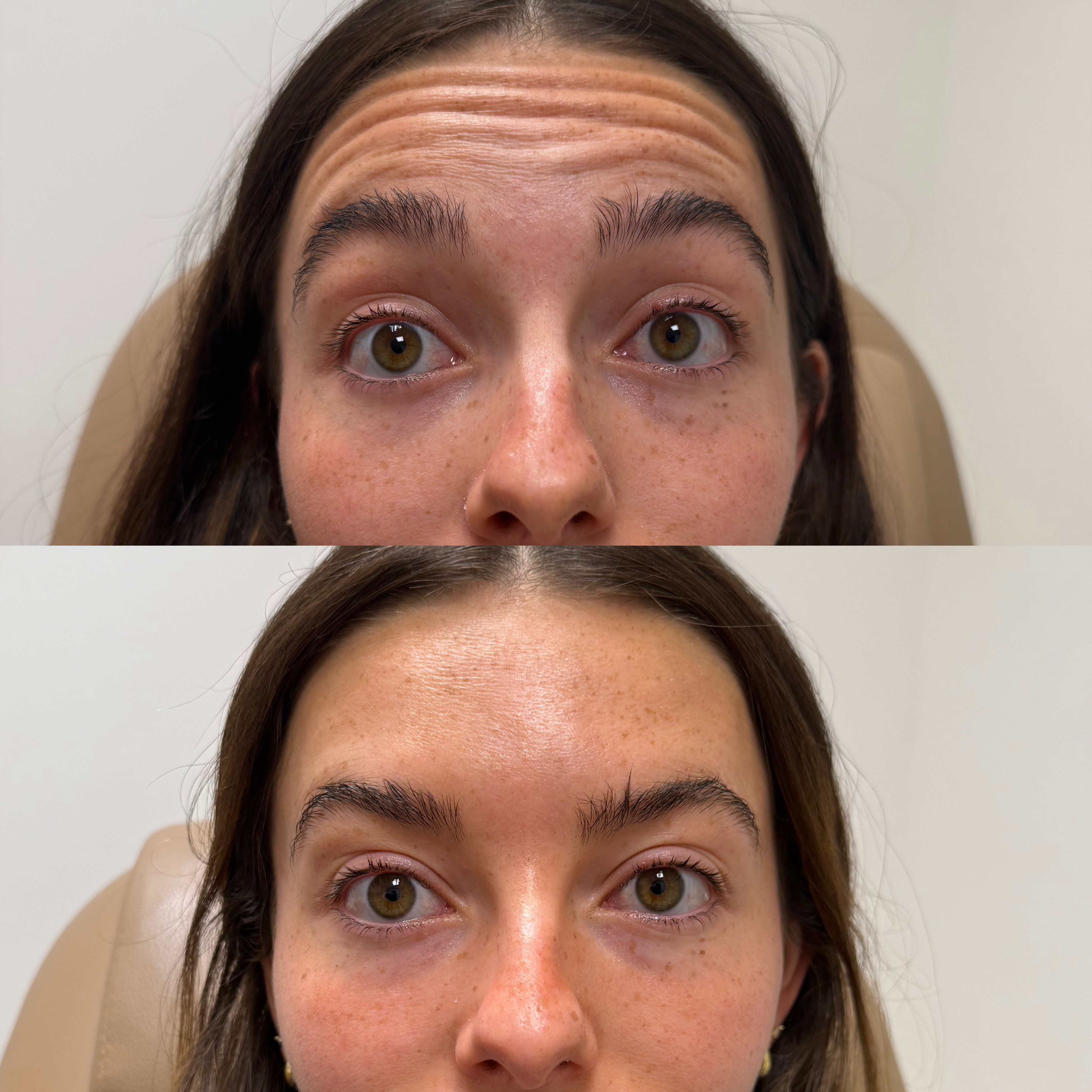 Smooth & refreshed✨💉 These before & afters are the result of strategically placed neurotoxin
