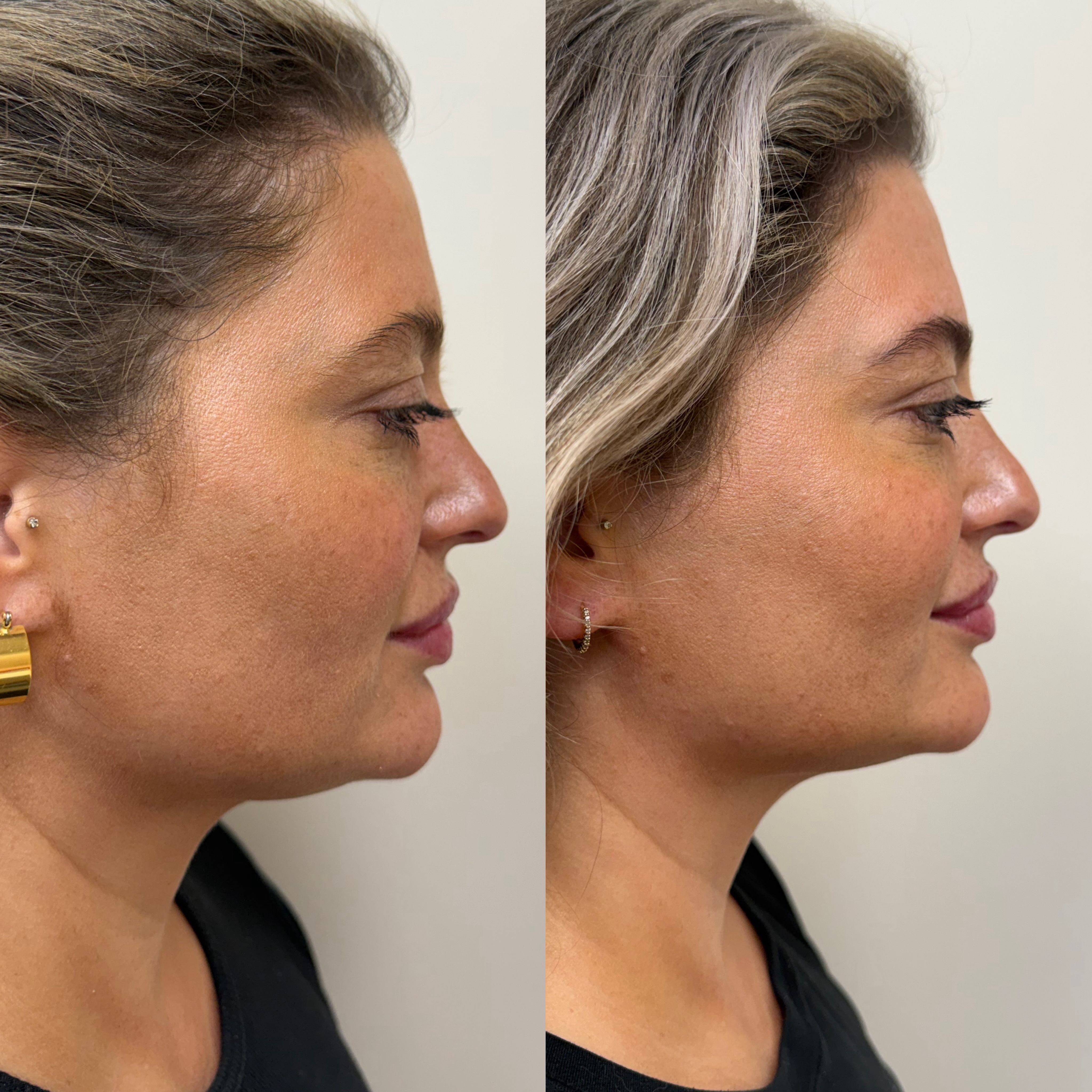 The Nefertiti Lift ✨💉 A subtle treatment that can make a beautiful difference. By