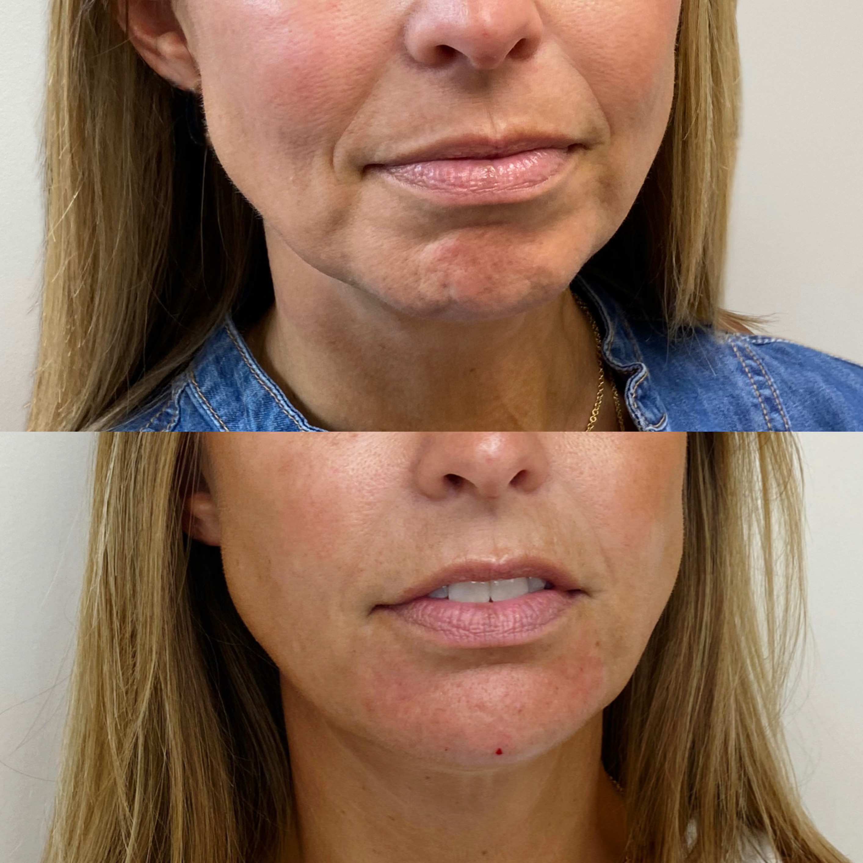 Lower face. Rejuvenated. Swipe to see where we injected. This result was achieved over