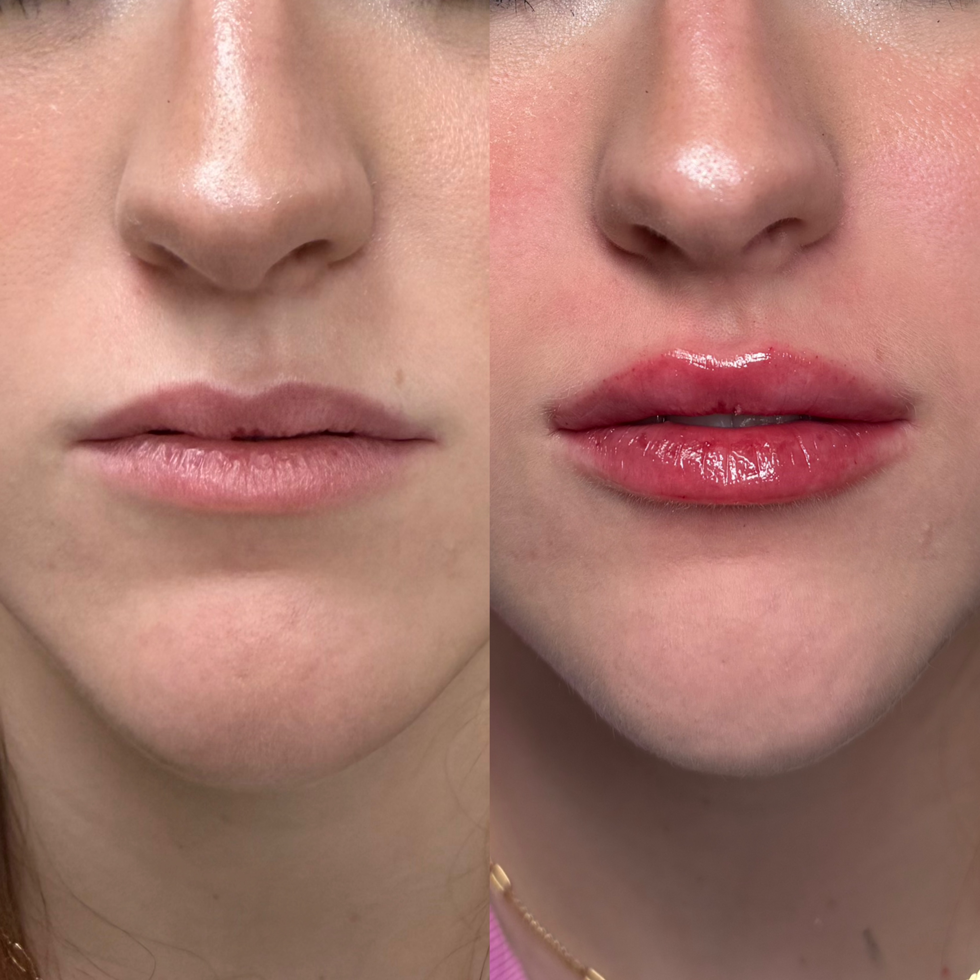 Correcting the M-shape with strategic placement for a softer, smoother, more balanced result 💉✨