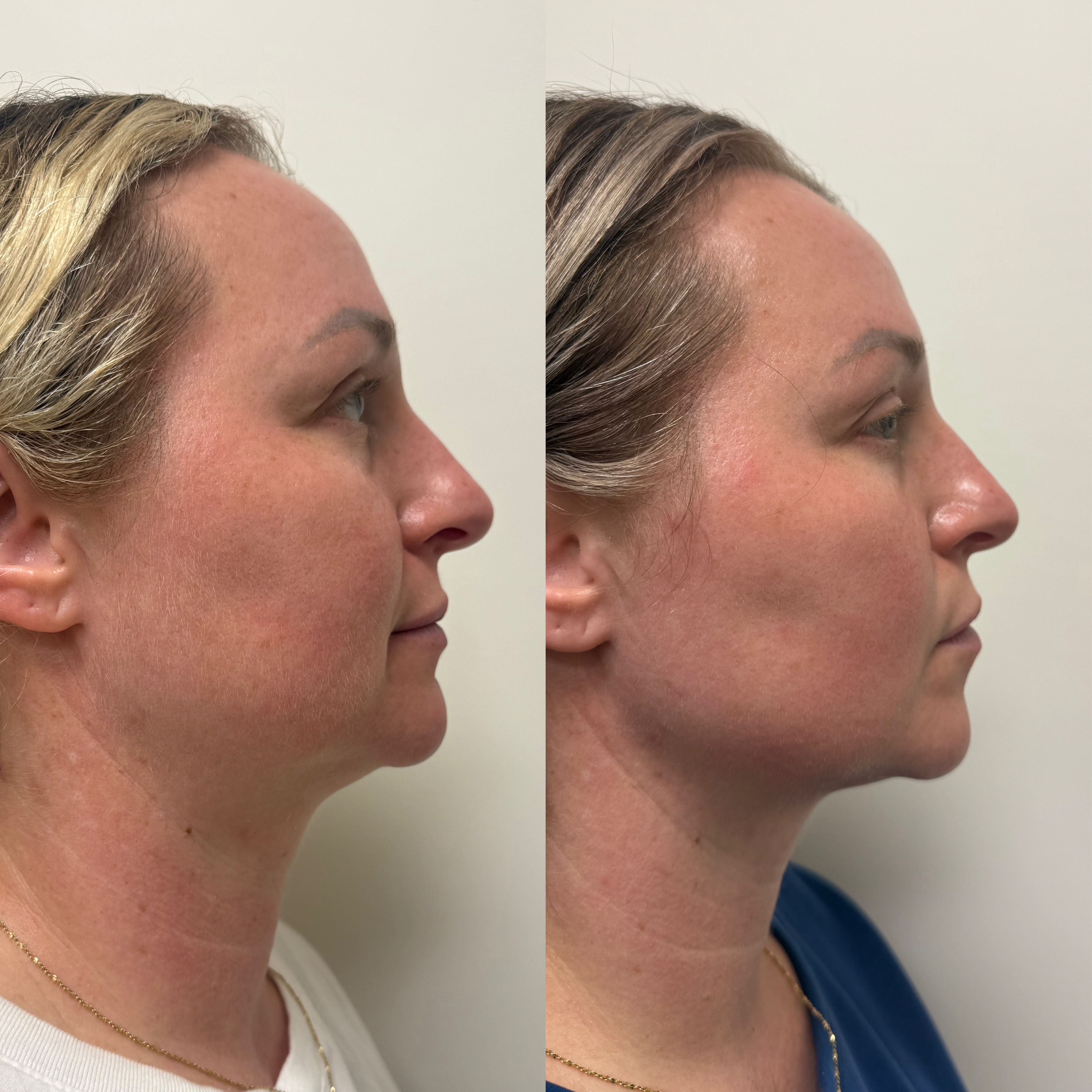 A more sculpted jawline—without adding volume. The Nefertiti Lift uses strategically placed neurotoxin to