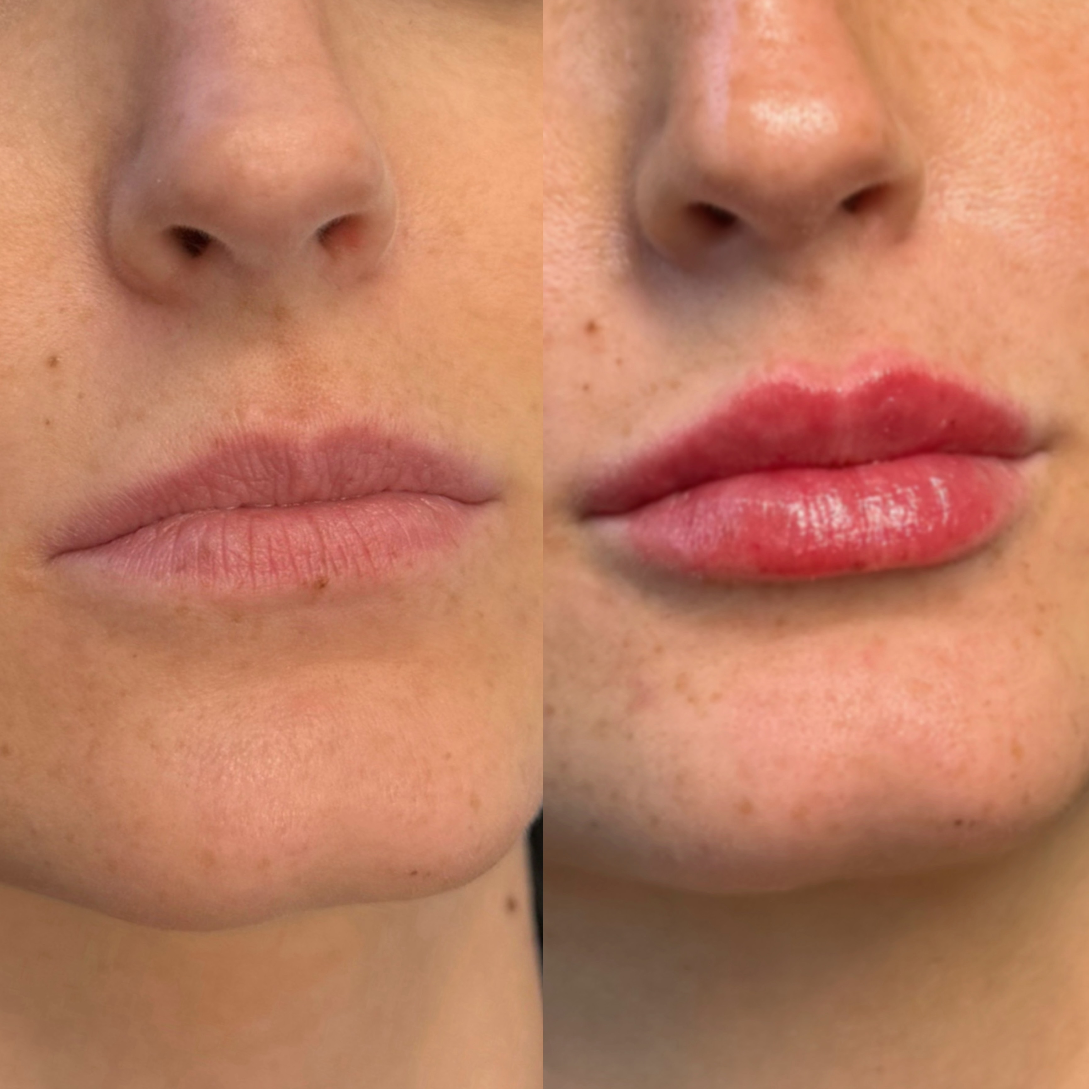 Lip refresh achieved over 3 lip sessions in a 6 month period! Thank you