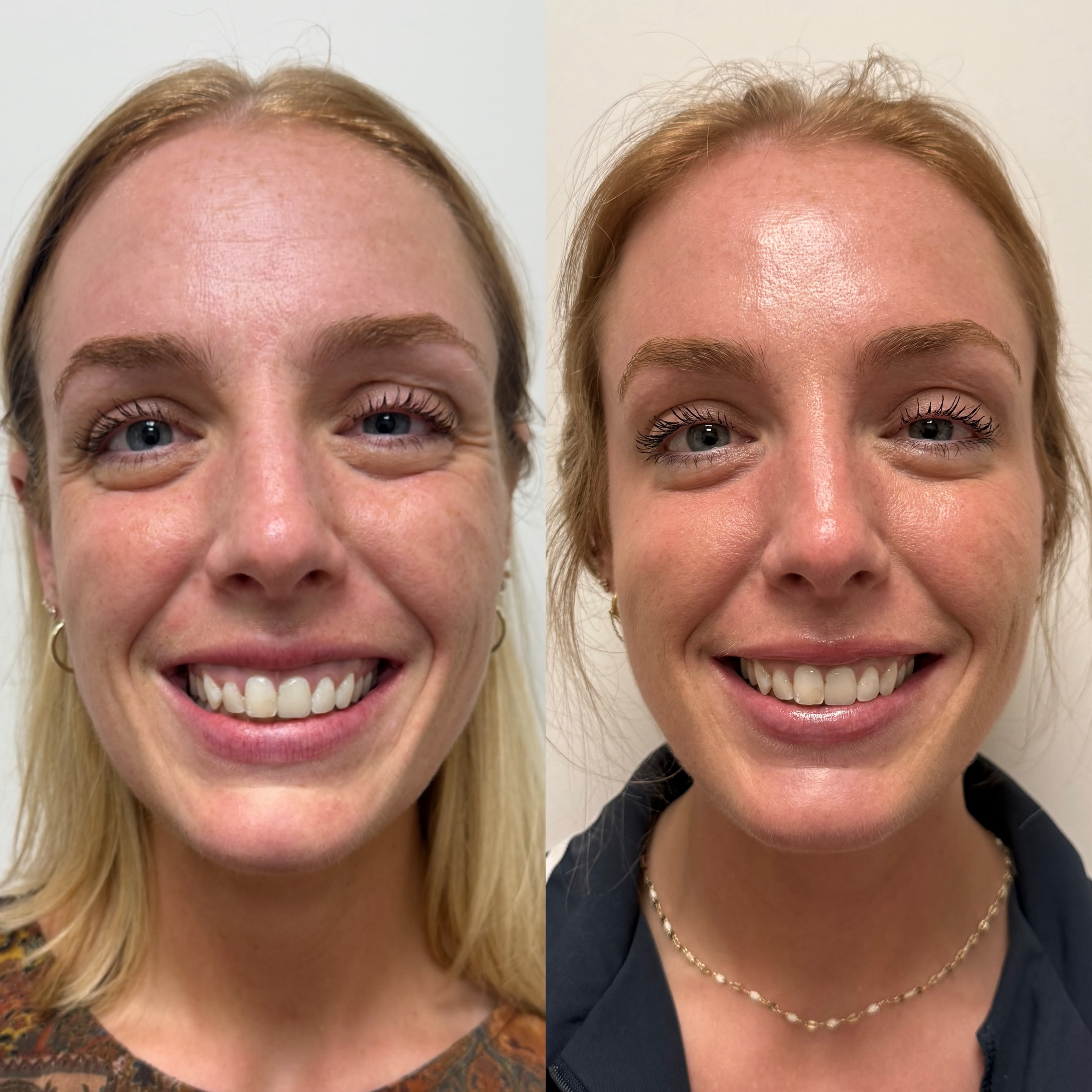 And that’s on tox👏🏻💉 What you see here is a more balanced upper face,