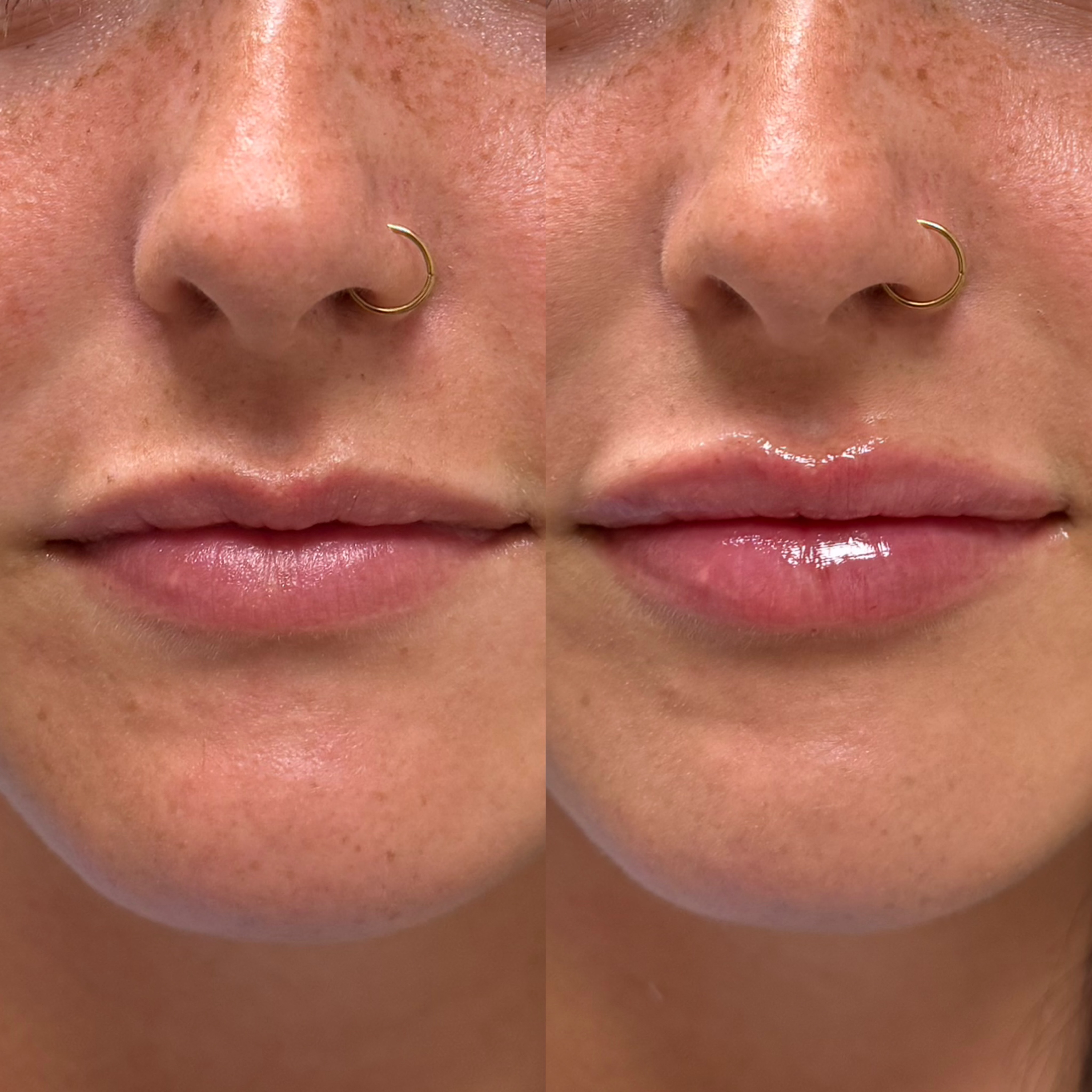 A subtle lip refresh focused on smoothing, balancing, and enhancing her natural shape💉✨ click