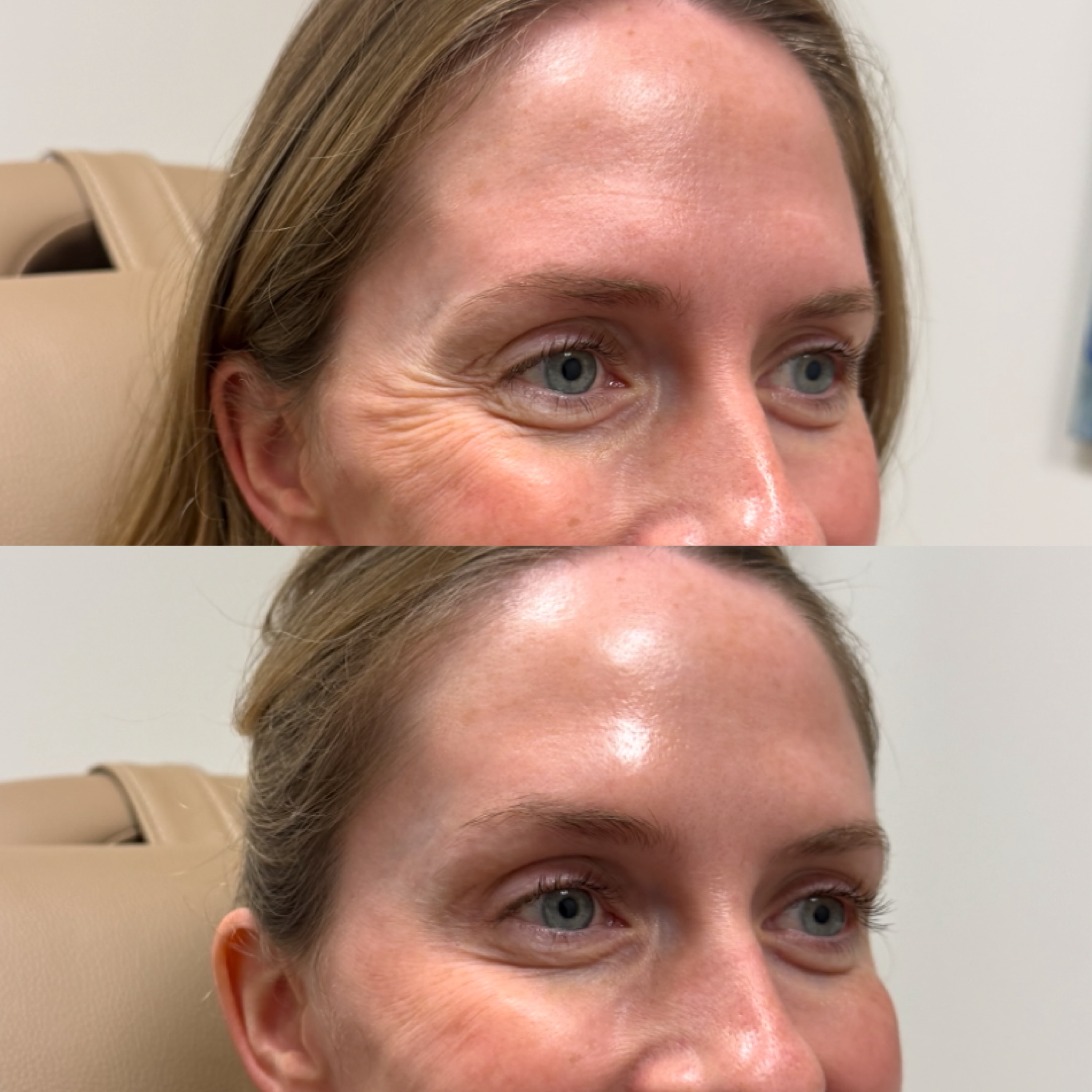 A subtle lift, a softer expression✨ Strategic neurotoxin to soften fine lines and create