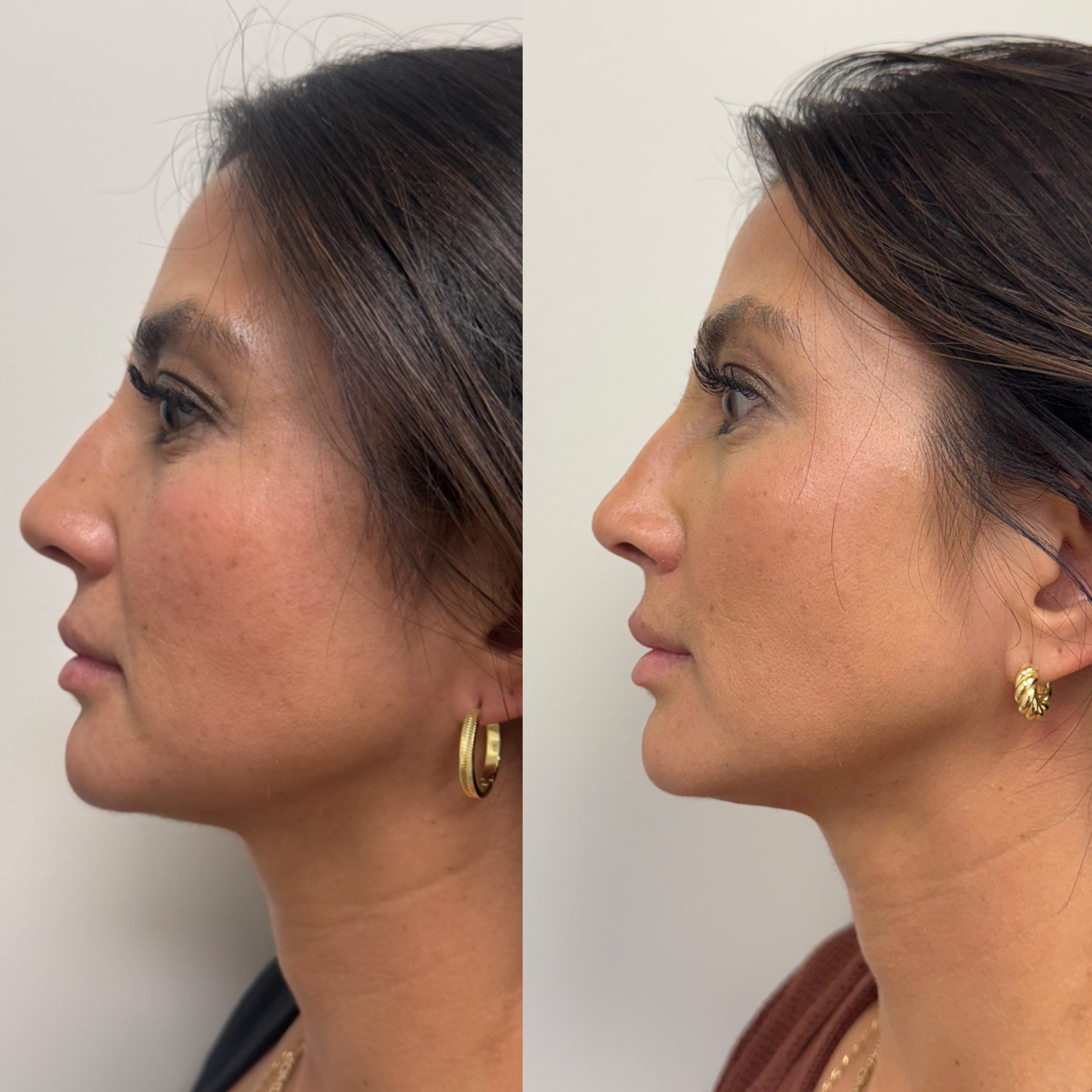 What did we treat? Strategic neurotoxin throughout the upper and lower face, including a