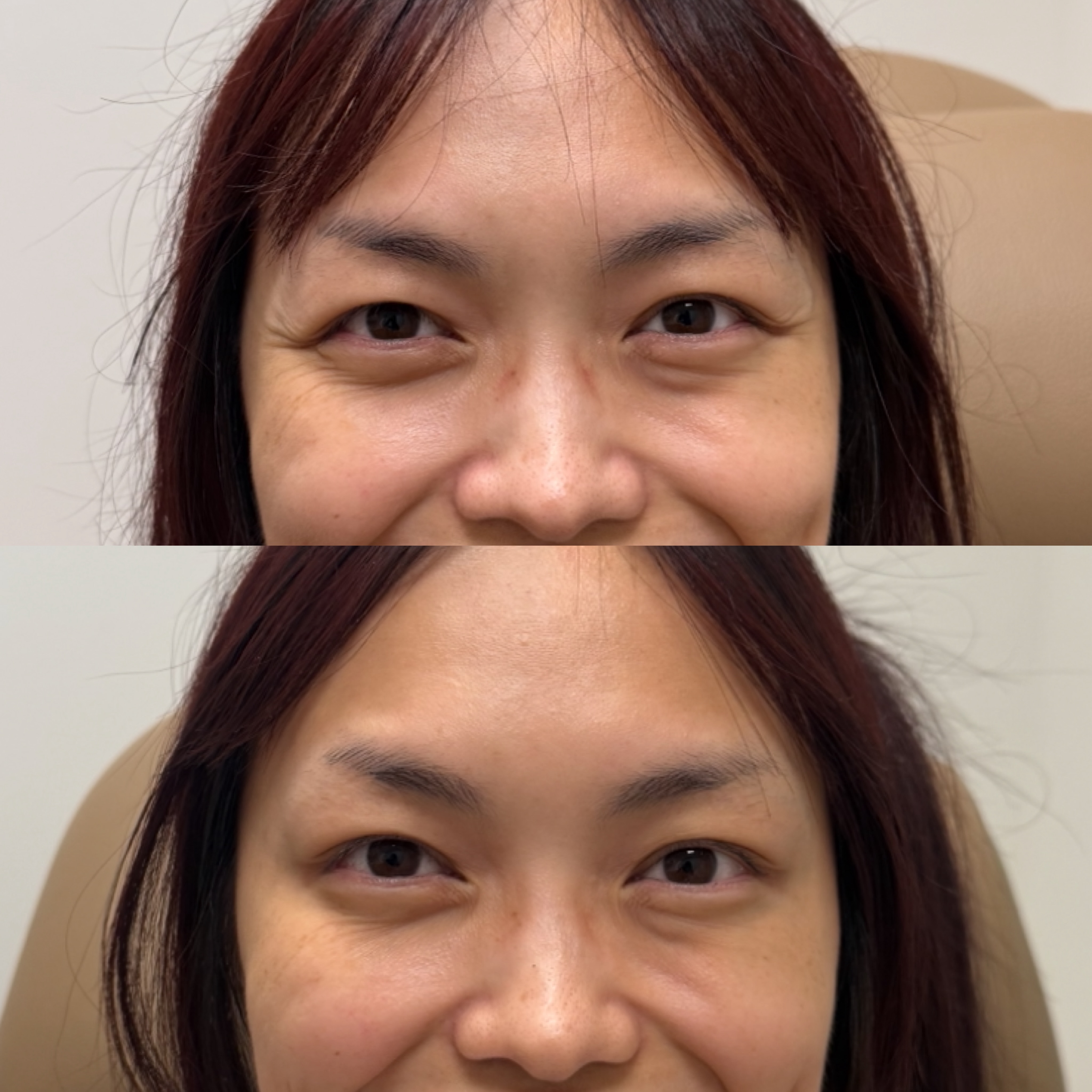 Softening the crow’s feet + glabella helps reduce repetitive muscle movement that can contribute